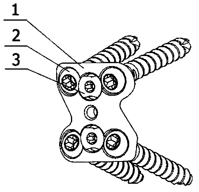 Lumbosacral anterior plate fixing device