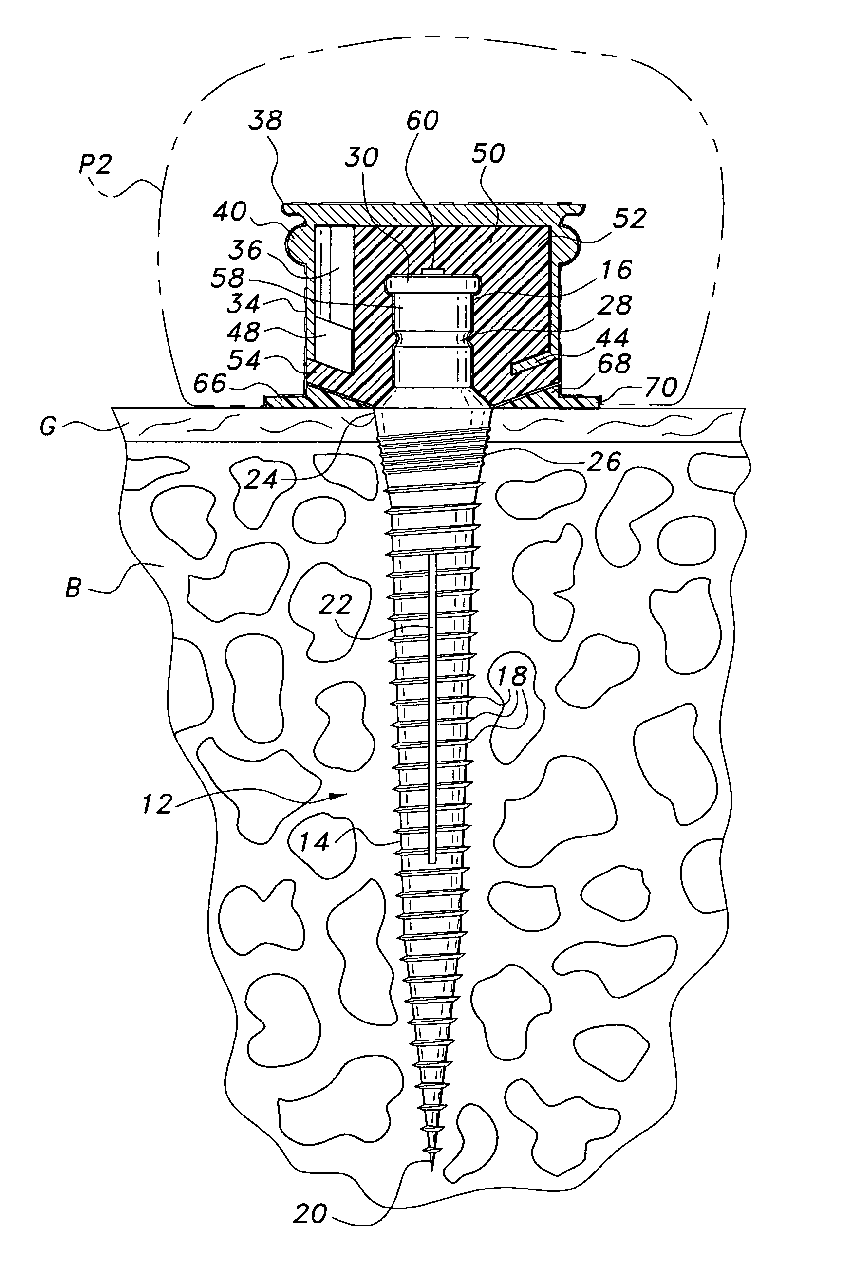 Dental implant system