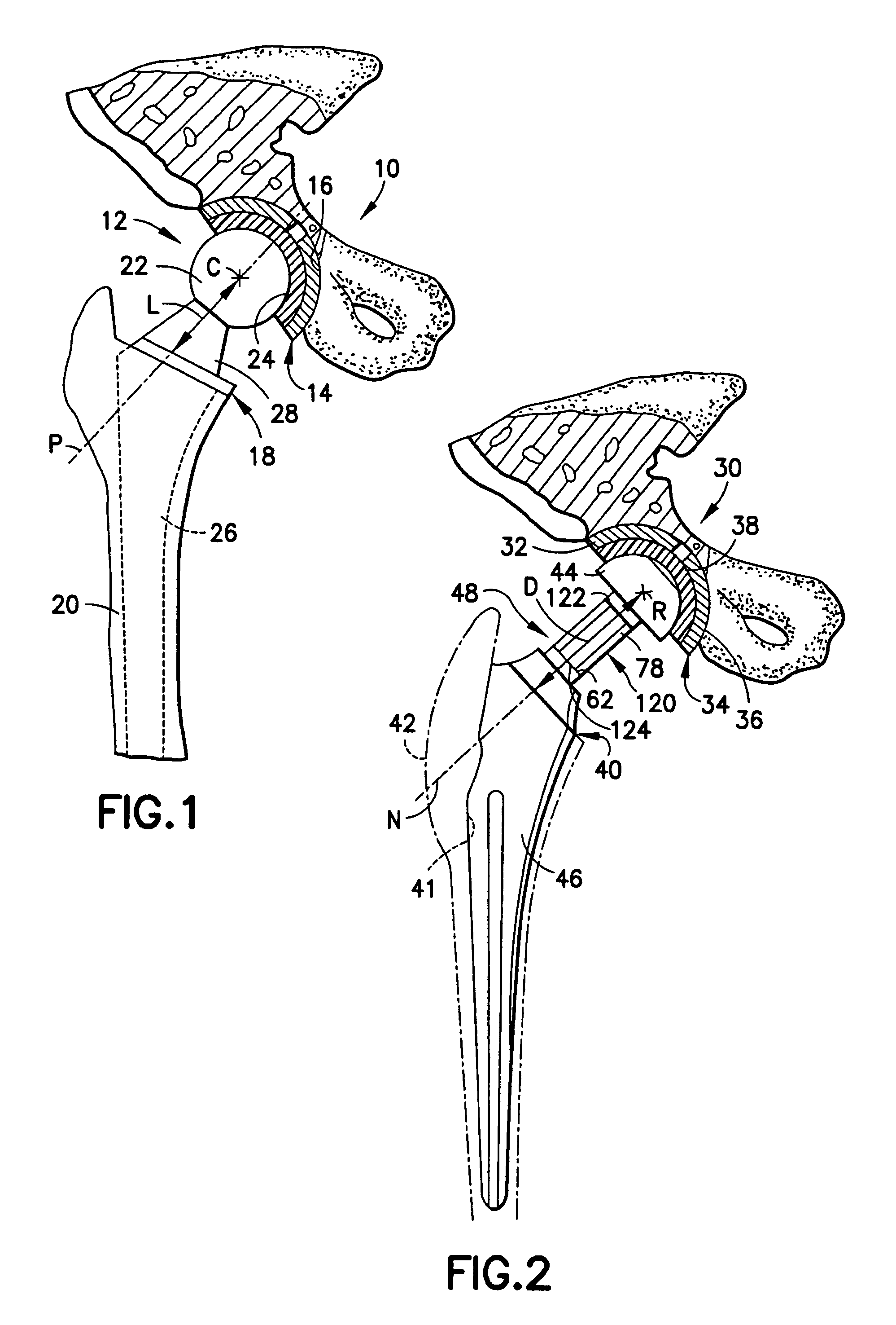 Hip arthroplasty trialing apparatus and method