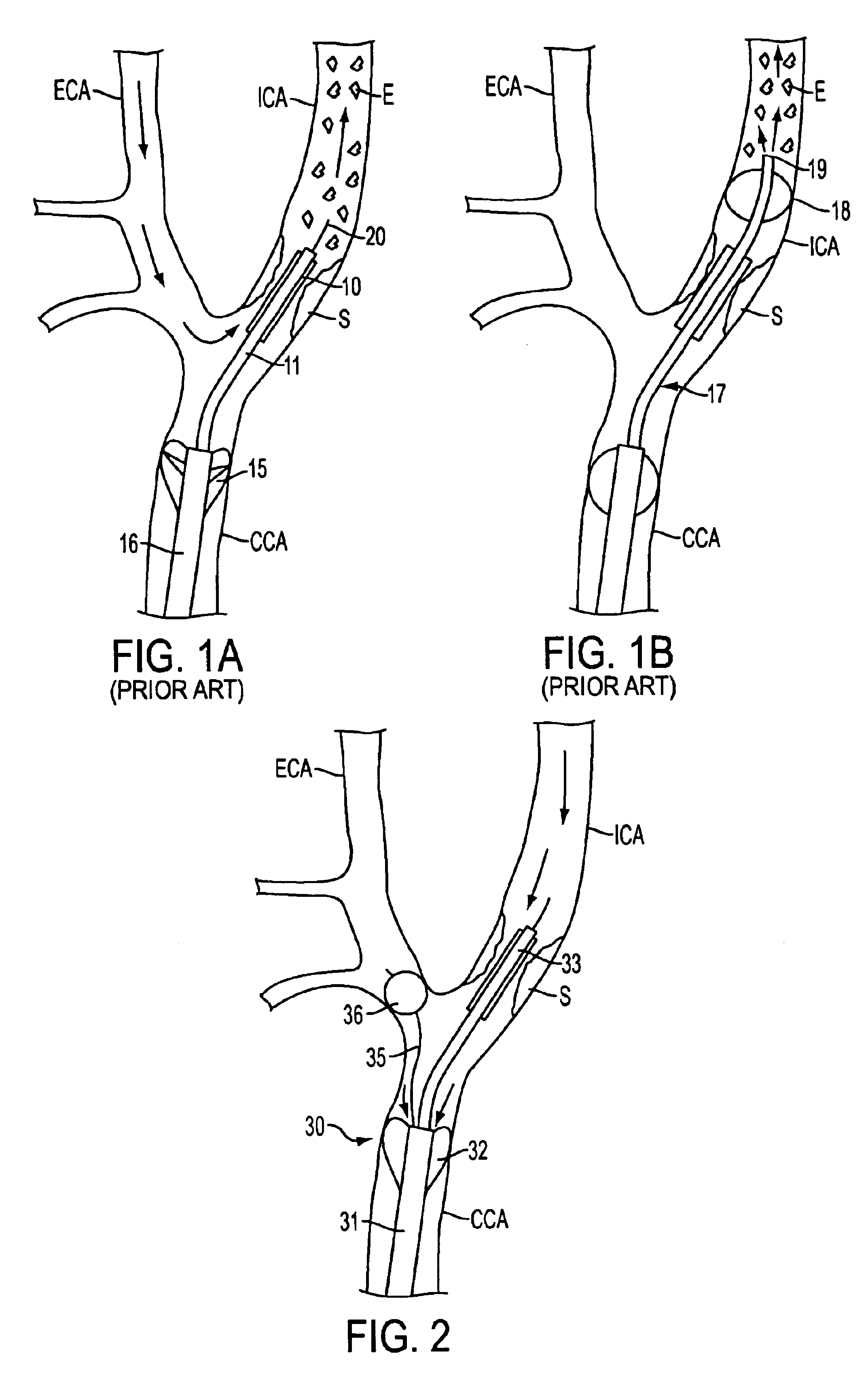 Apparatus and methods for reducing embolization during treatment of carotid artery disease