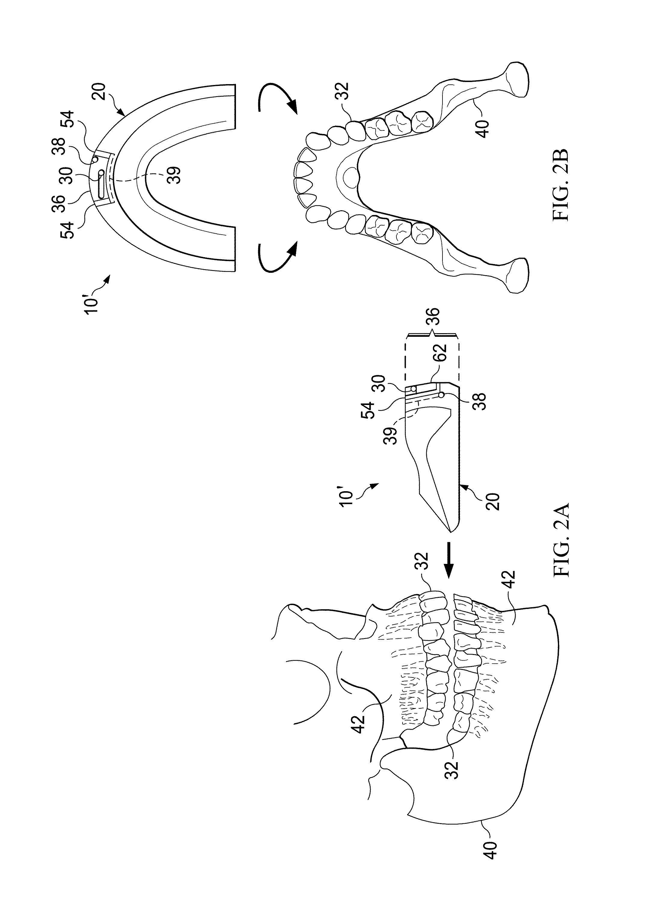 Vibrating orthodontic remodeling device and method thereof