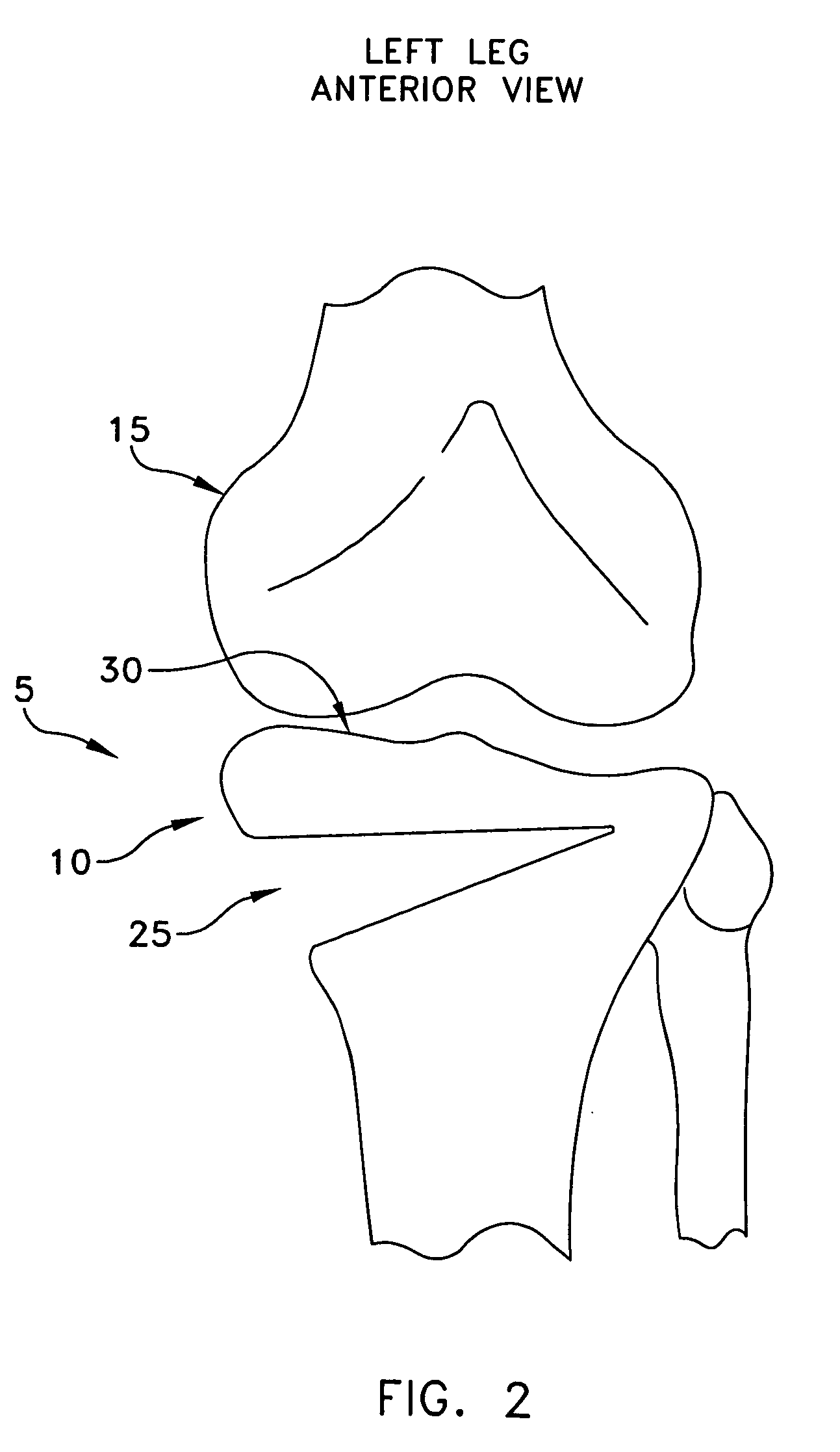 Method and apparatus for performing an open wedge, high tibial osteotomy