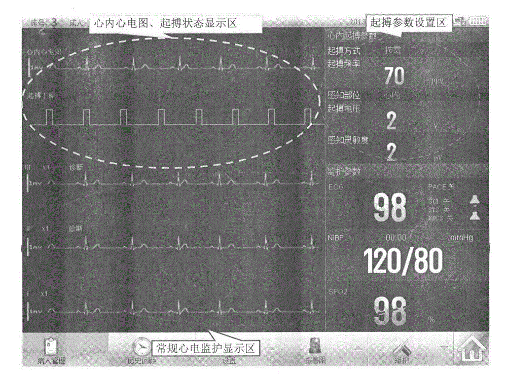 Alternative technology of invasive temporary cardiac on-demand pacing sensing source