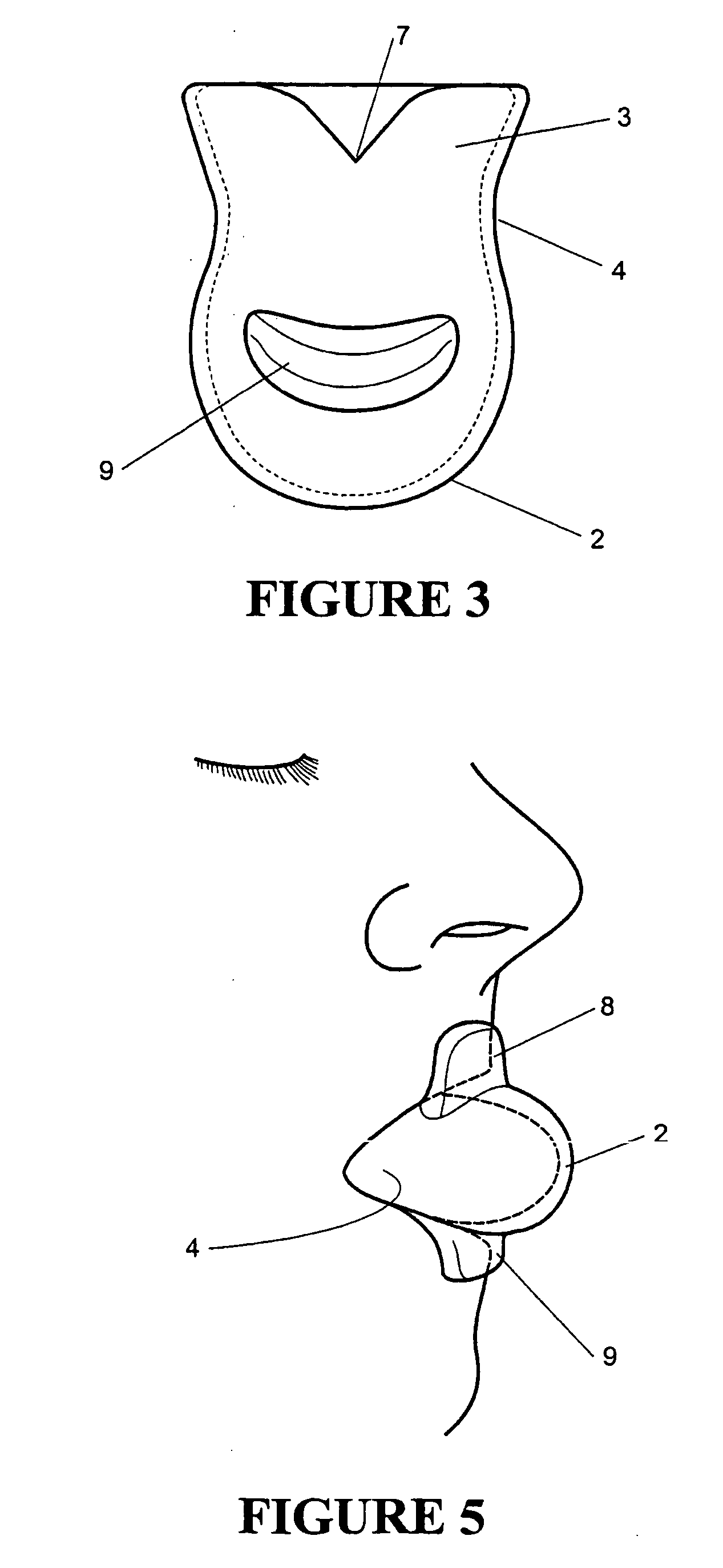 Tongue stabilising device