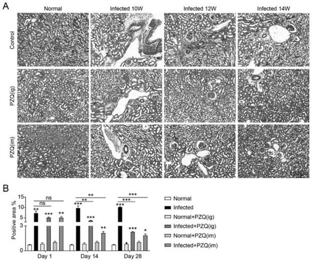 Application of praziquantel in resisting renal fibrosis diseases