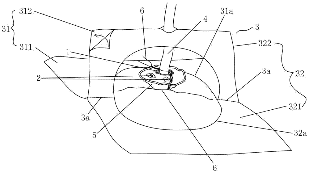 Novel bridge type fixing method for umbilical artery and vein catheter of newborn baby