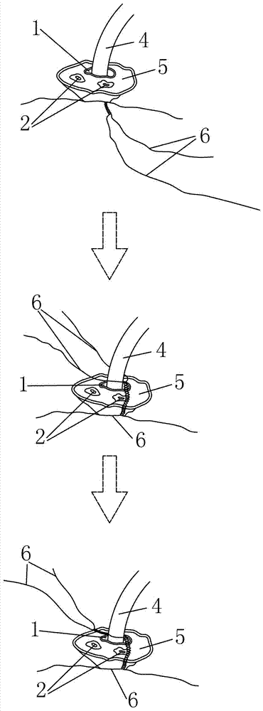 Novel bridge type fixing method for umbilical artery and vein catheter of newborn baby