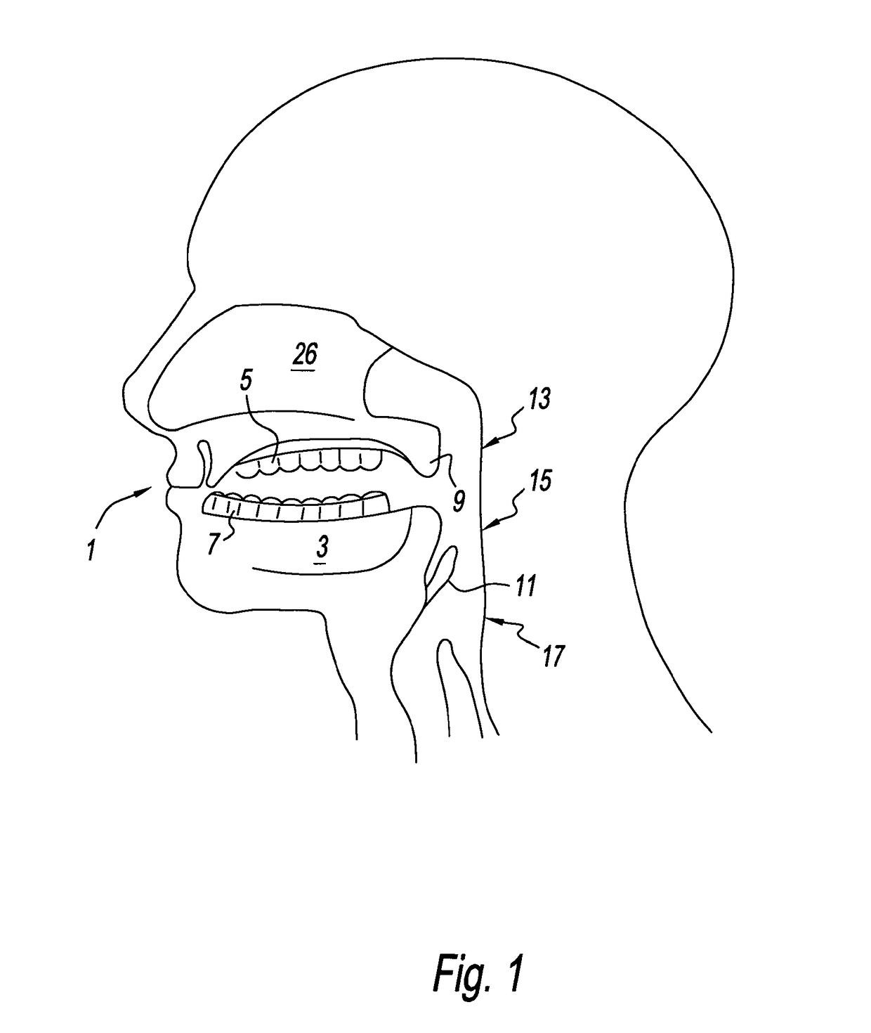 Palate retainer with attached nasopharyngeal airway extender for use in the treatment of obstructive sleep apnea