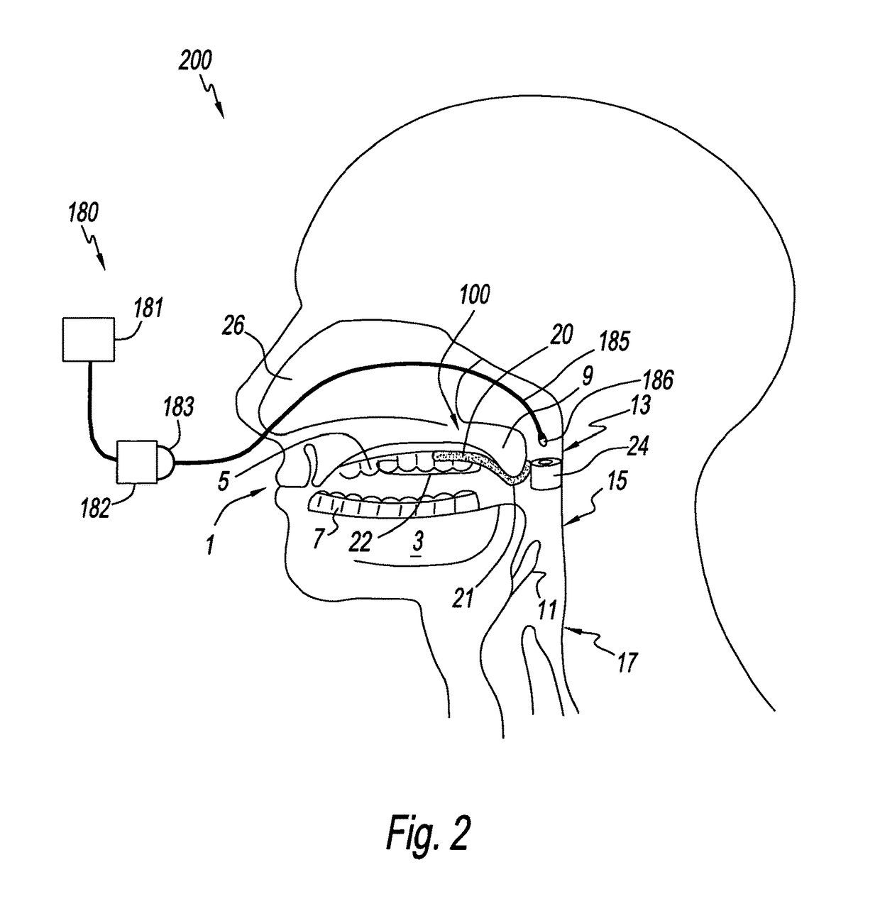 Palate retainer with attached nasopharyngeal airway extender for use in the treatment of obstructive sleep apnea