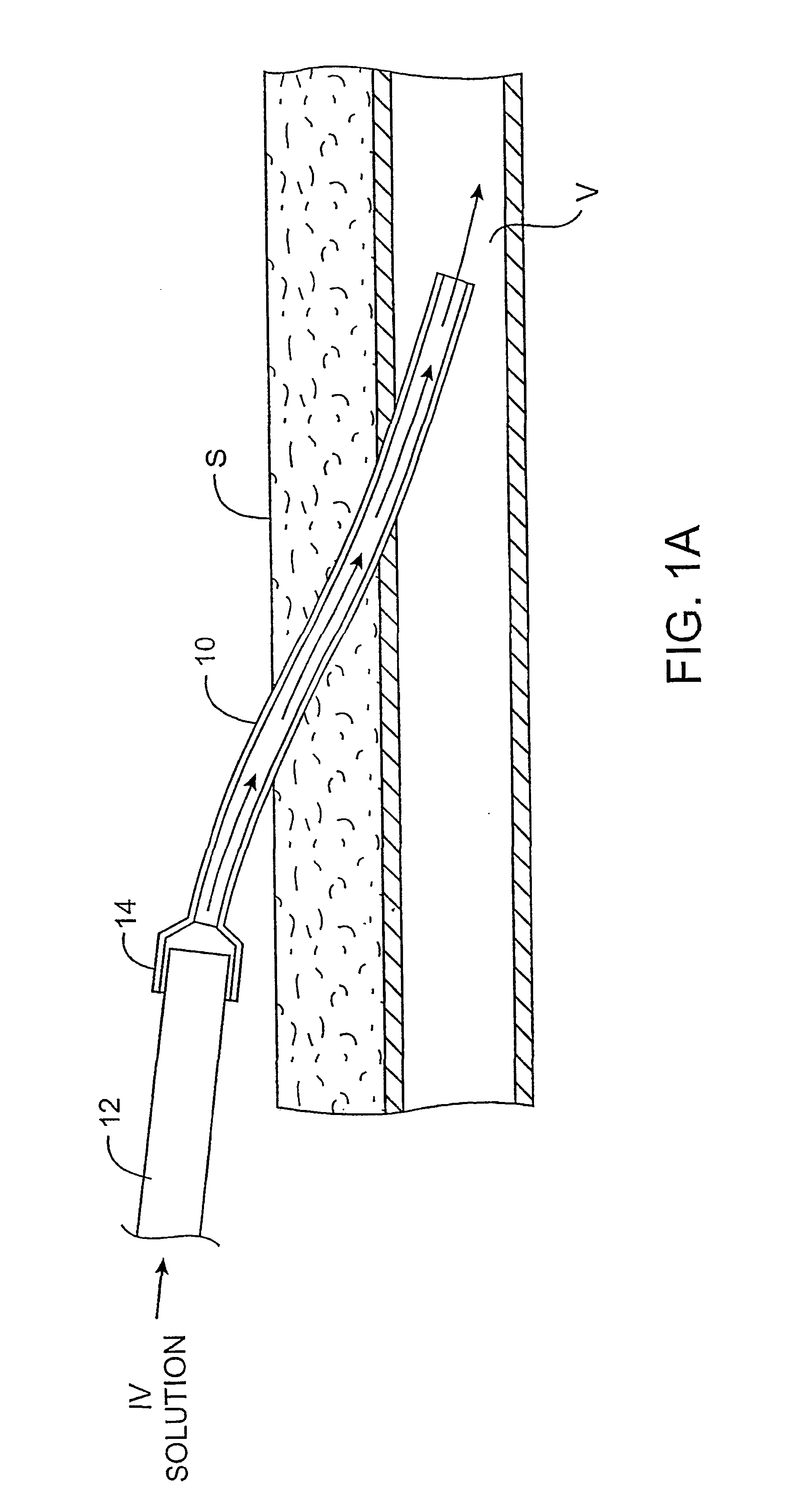 Methods and kits for locking and disinfecting implanted catheters