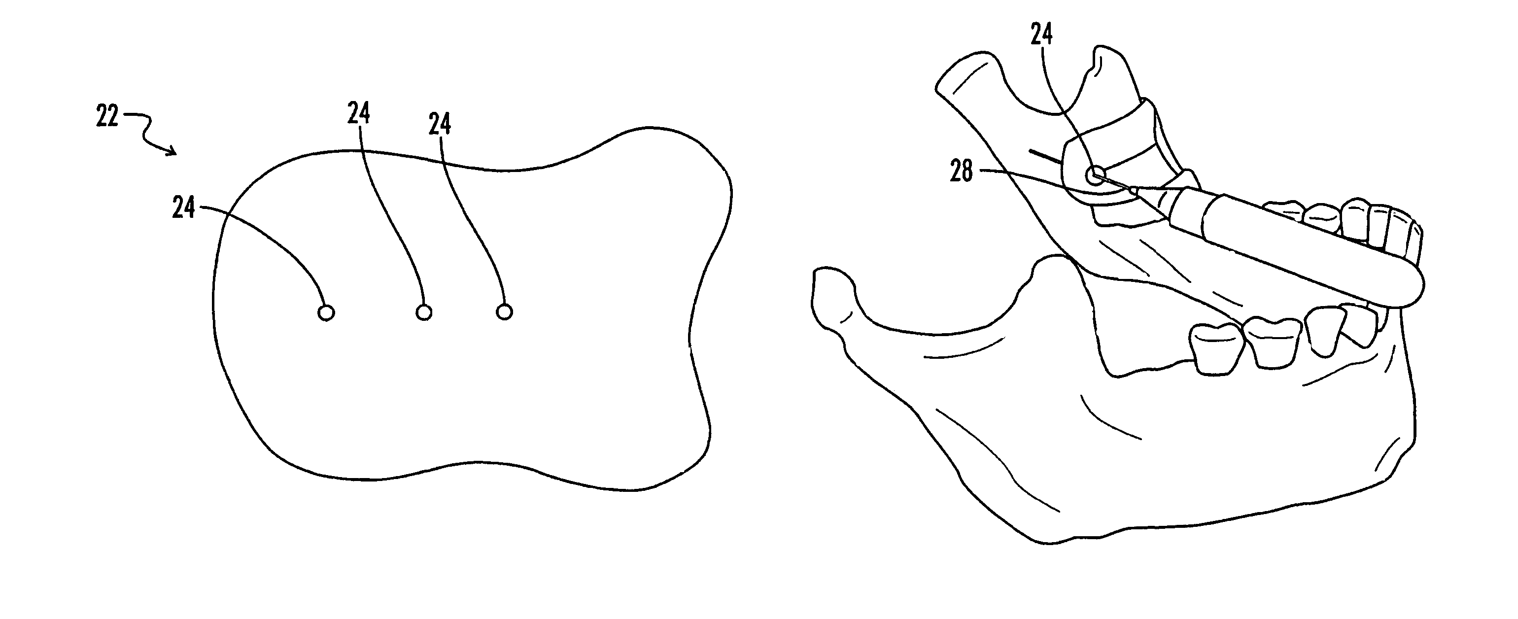 Inferior alveolar nerve block guide