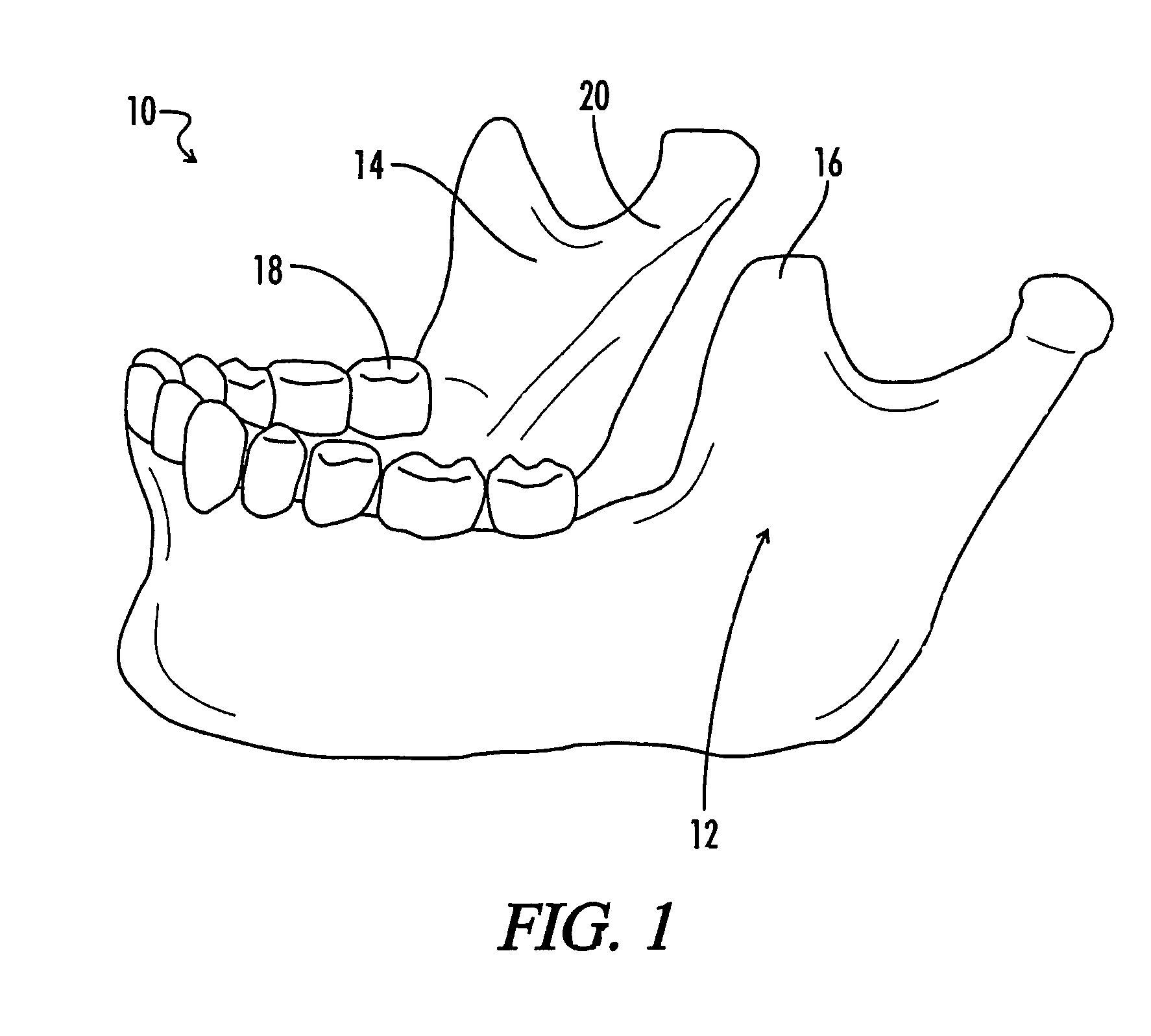 Inferior alveolar nerve block guide