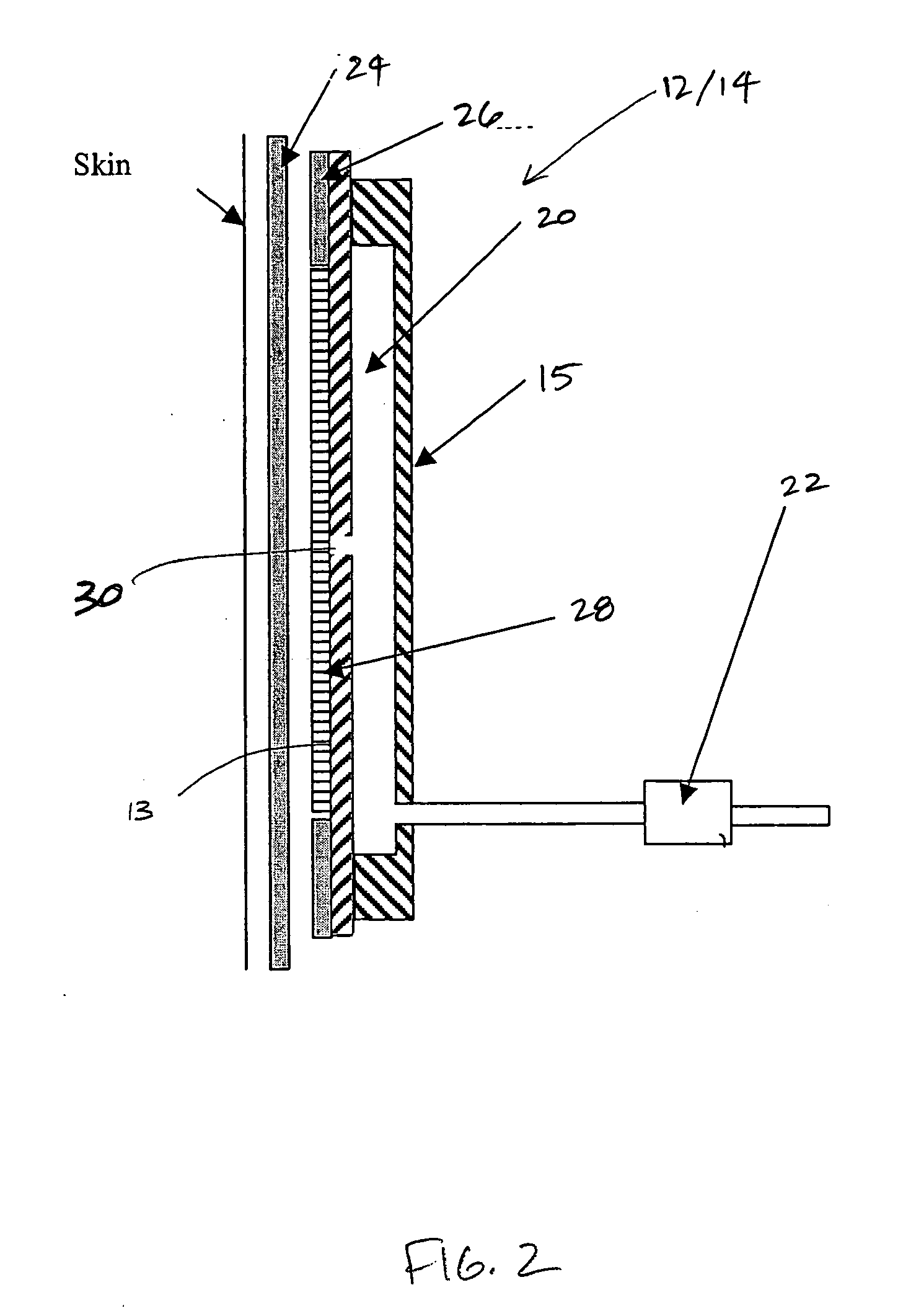 Orthopedic brace having a vacuum chamber and associated methods