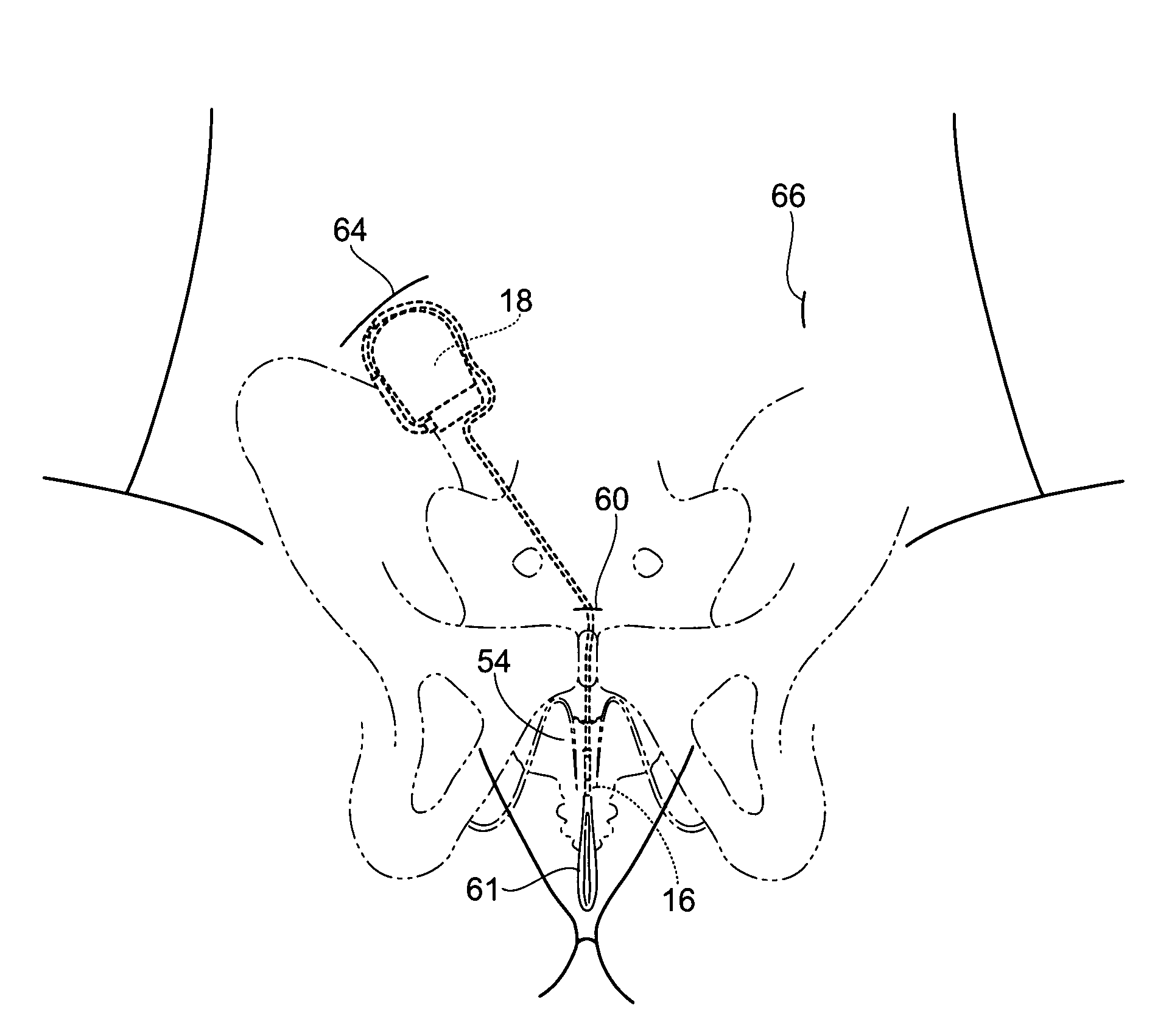 Stimulation of dorsal genital nerves to treat urologic dysfunctions