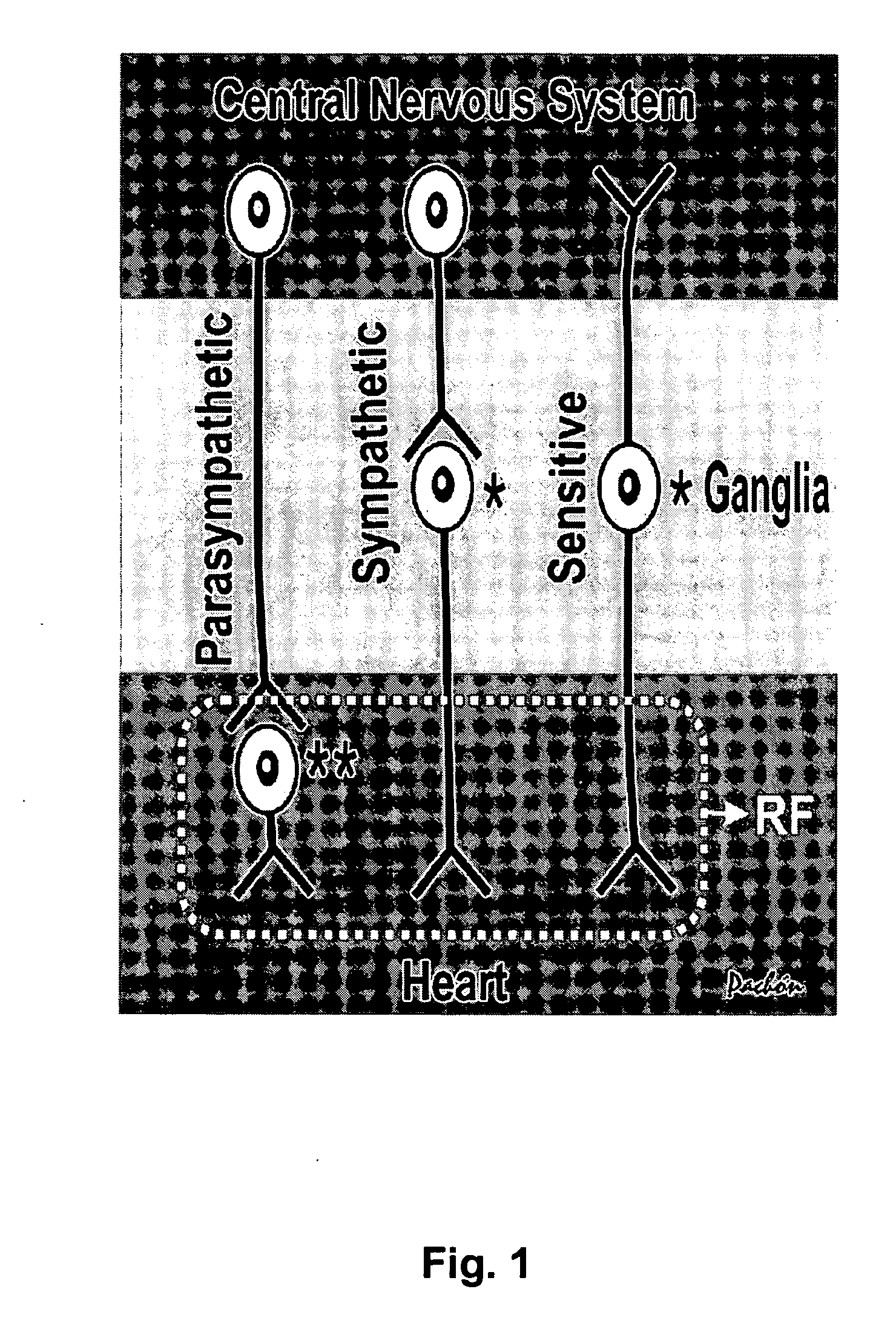 Method for arrhythmias treatment based on spectral mapping during sinus rhythm