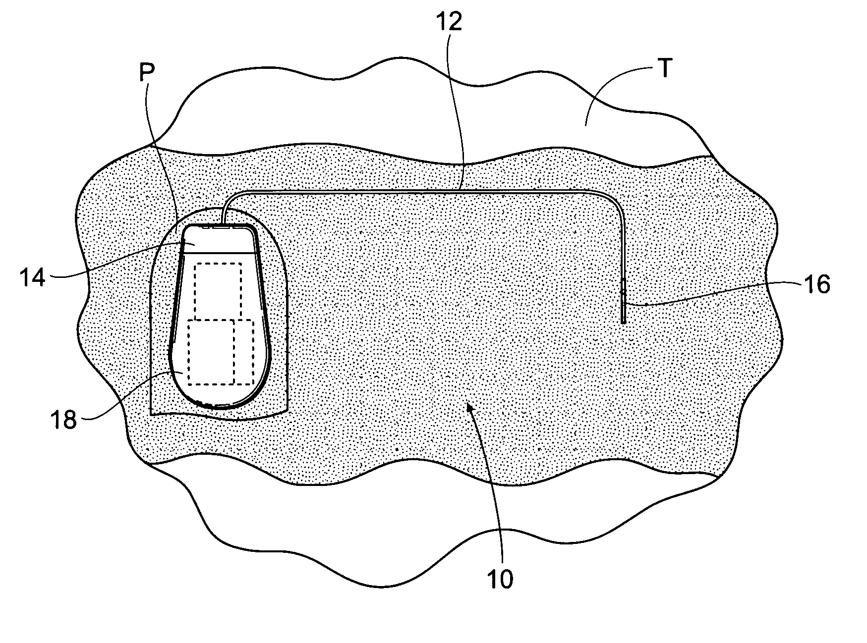 Implantable pulse generator for providing functional and/or therapeutic stimulation of muscles and/or nerves and/or central nervous system tissue