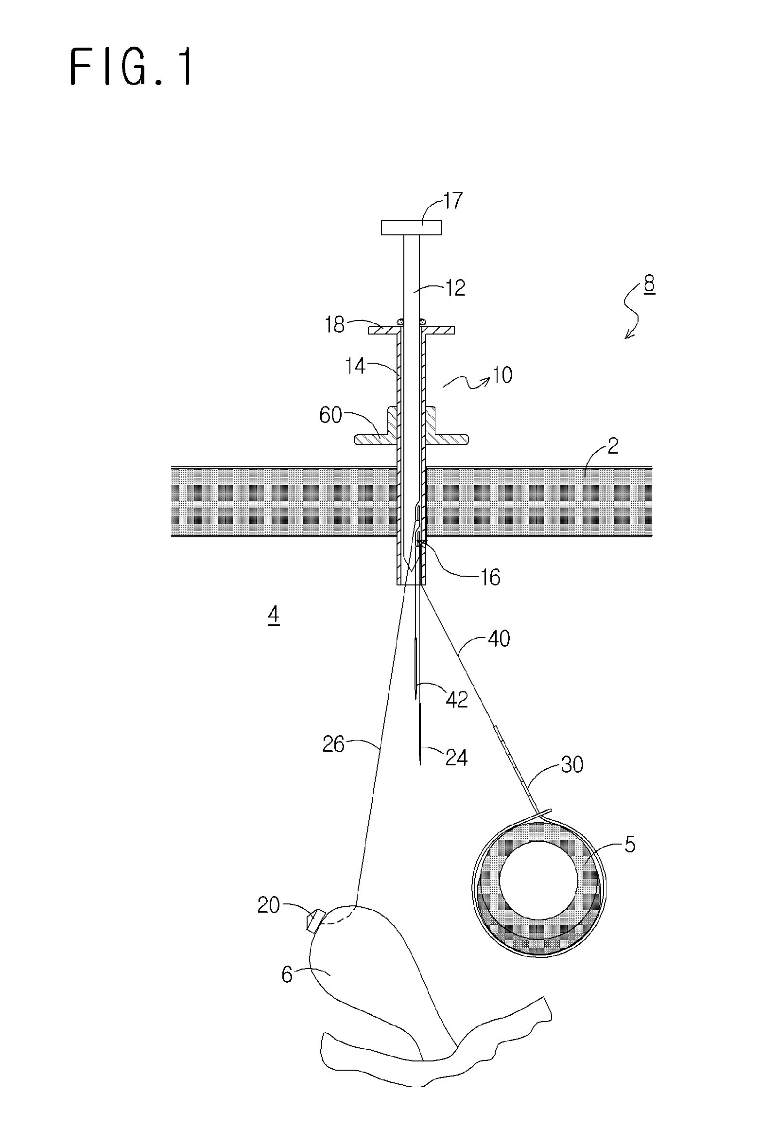 Retraction device for laparoscopy