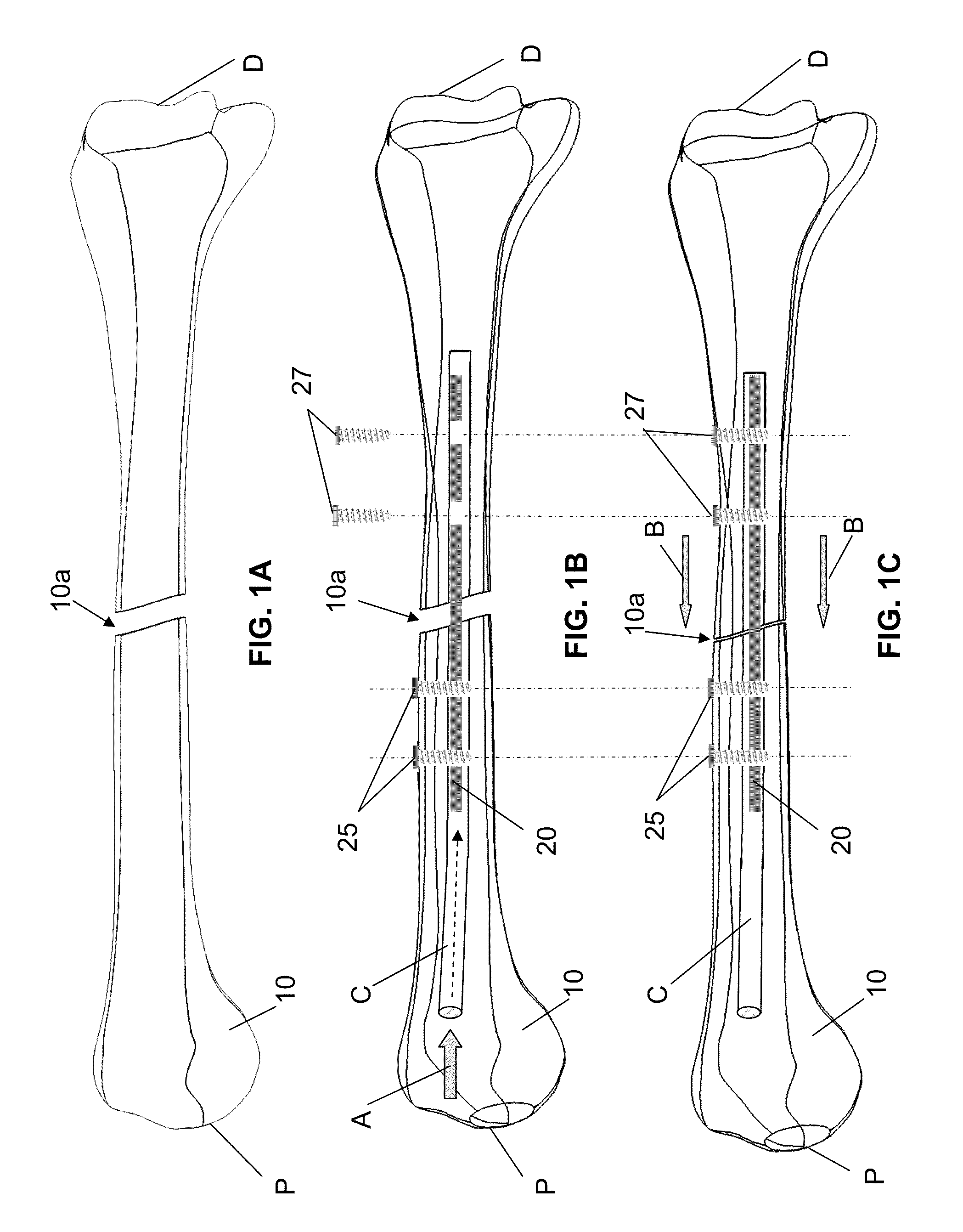 Endosteal nail plate for fixing bone segments