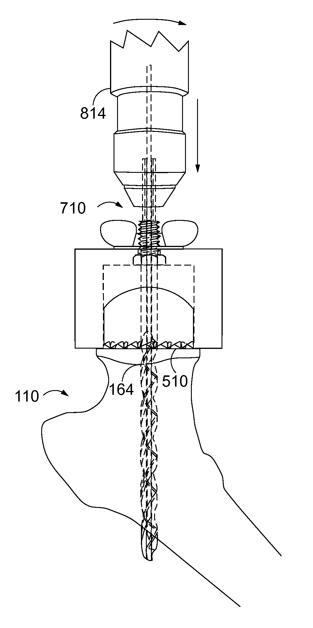 System for modular hip resurfacing