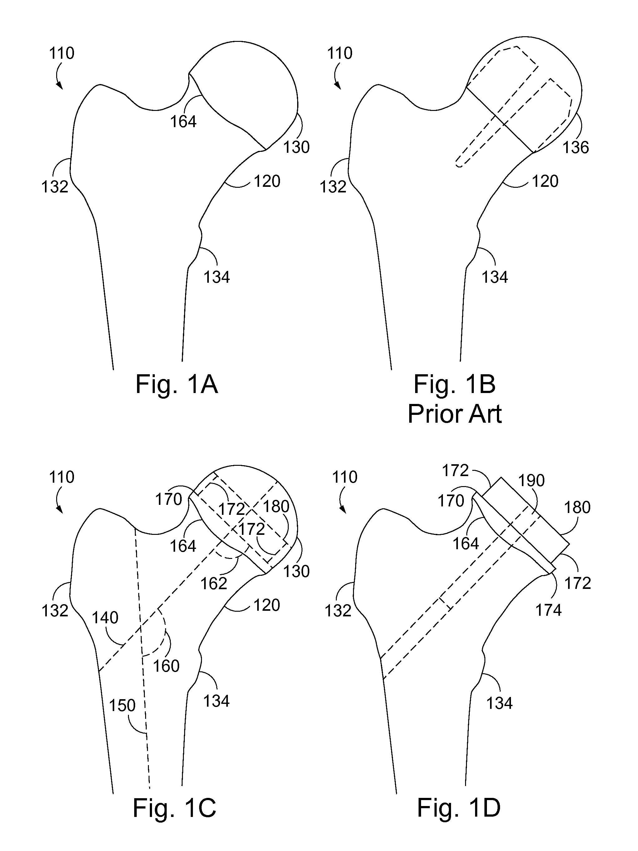 System for modular hip resurfacing