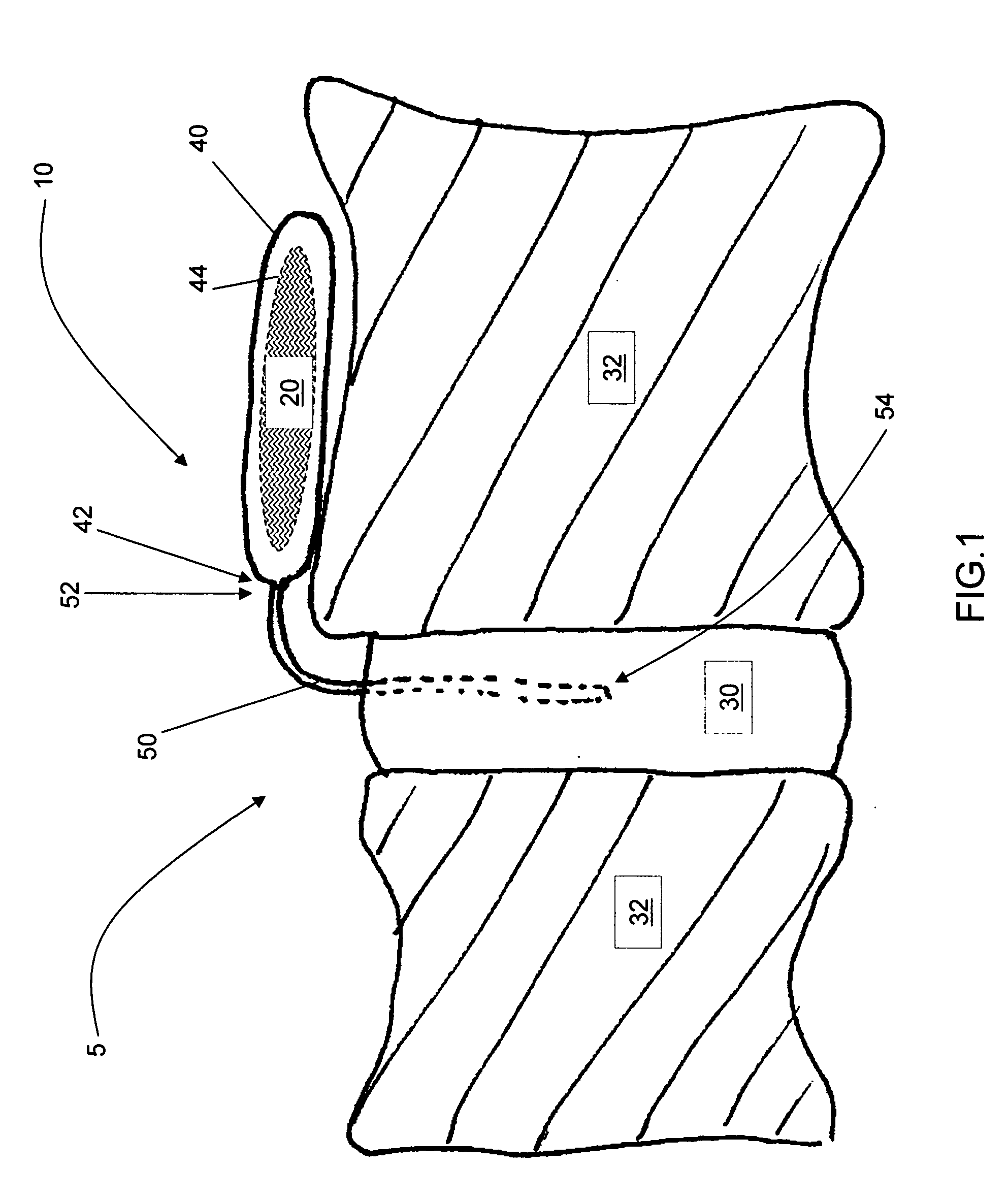 Release of BMP, bioactive agents and/or cells via a pump into a carrier matrix