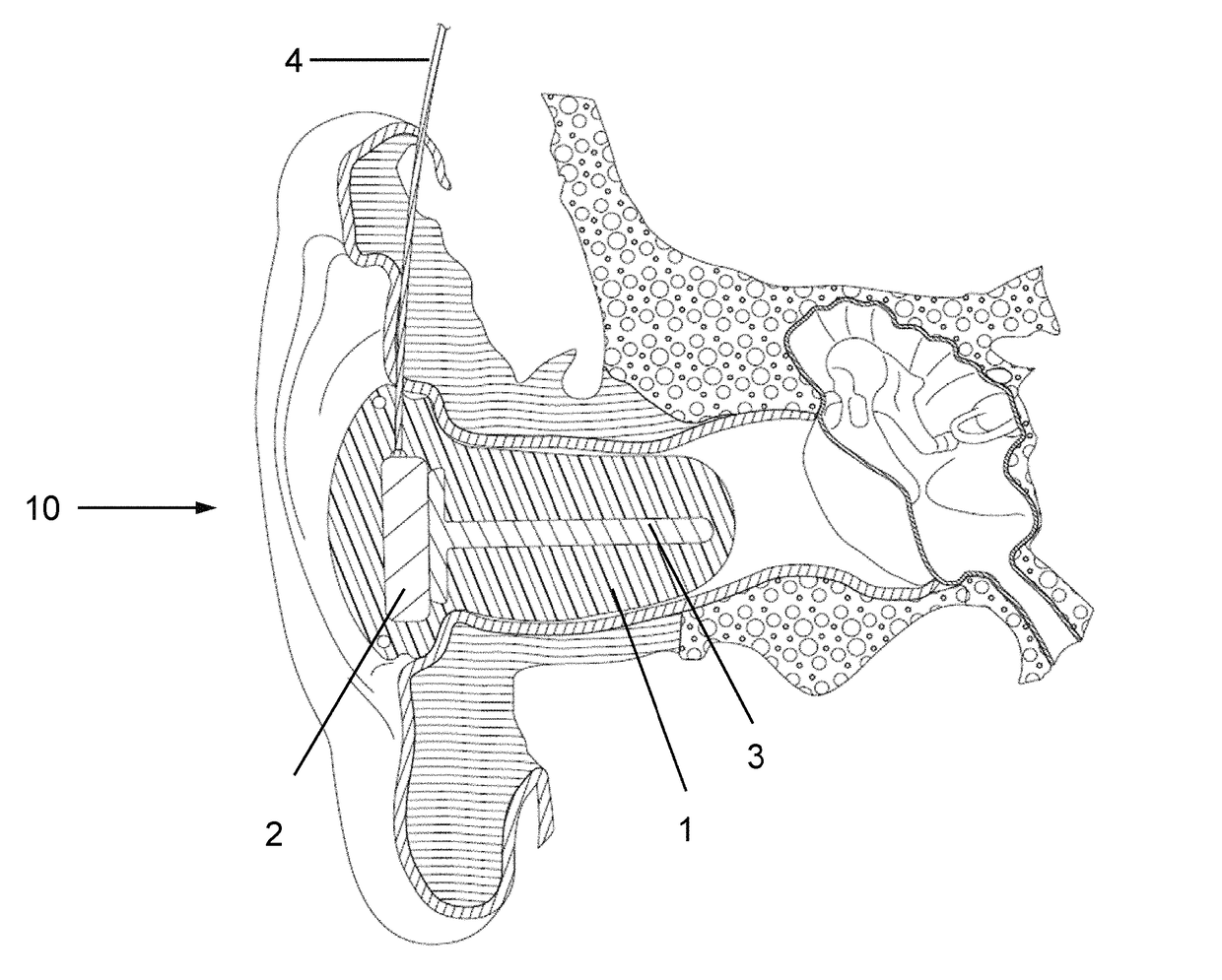 Device, system and method for reducing headache pain