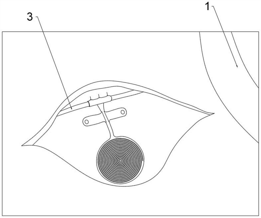 Device for inducing nerve rehabilitation and regeneration through radio stimulation