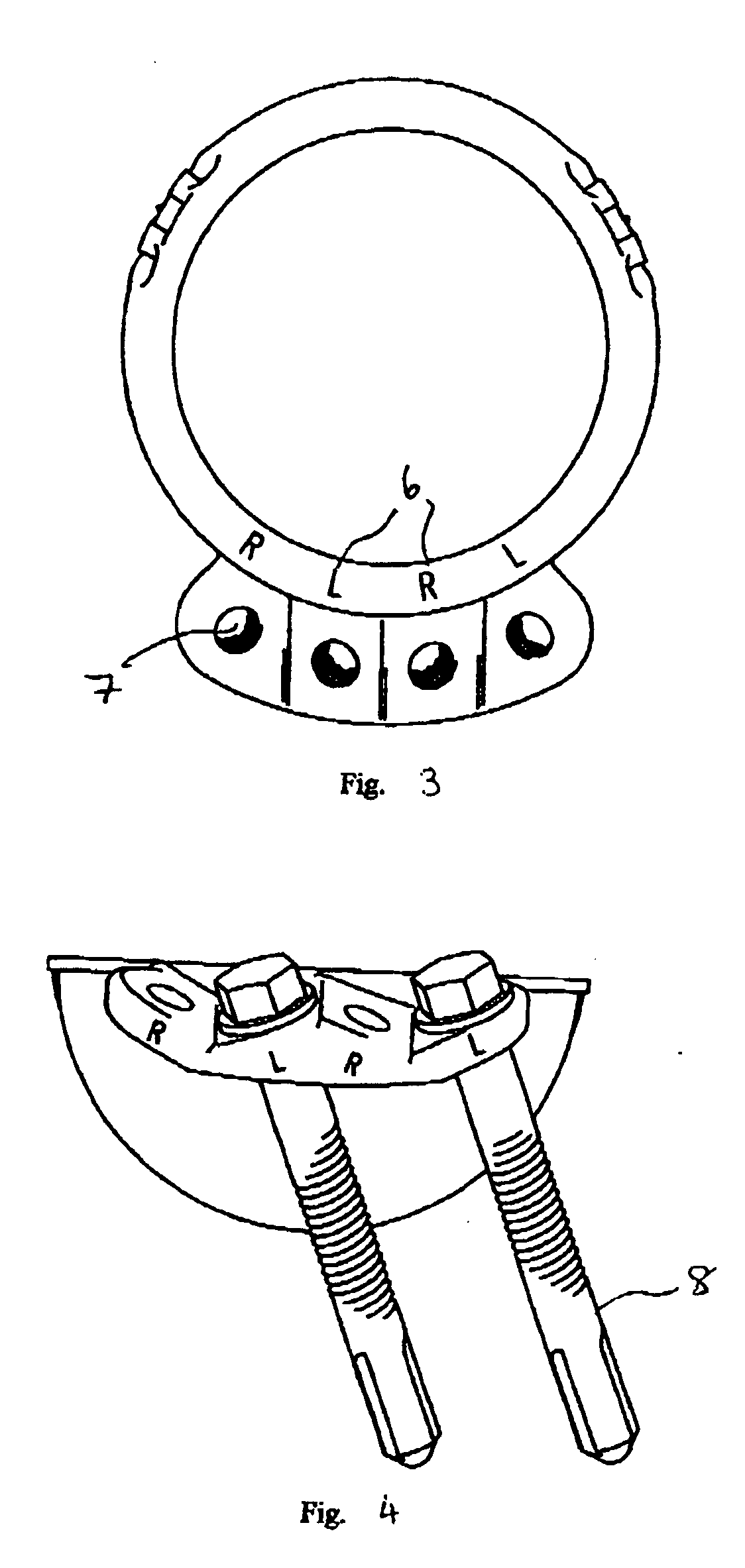 Prosthesis