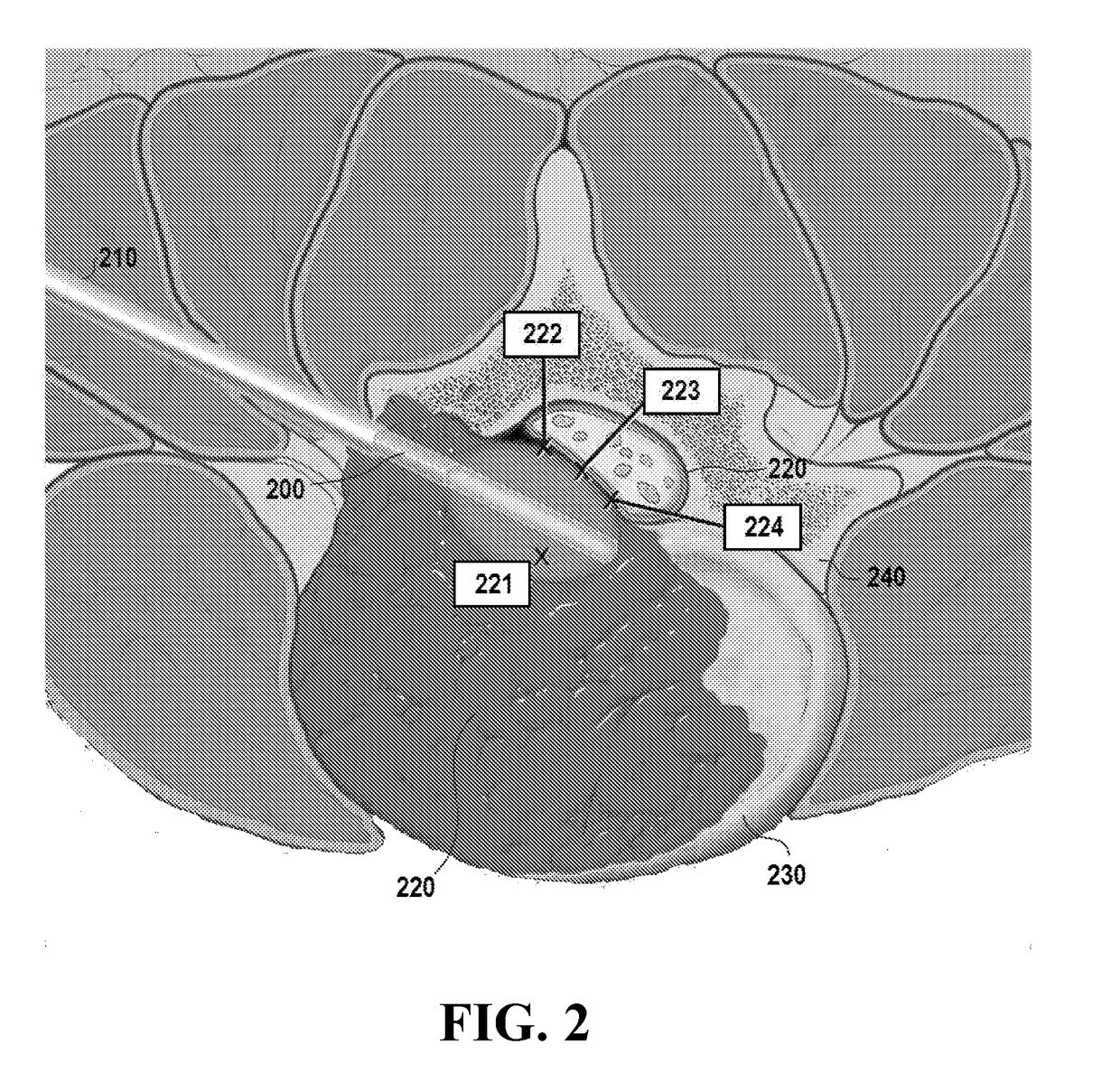 Utilization of laser interstitial thermotherapy guided with real time thermal MRI