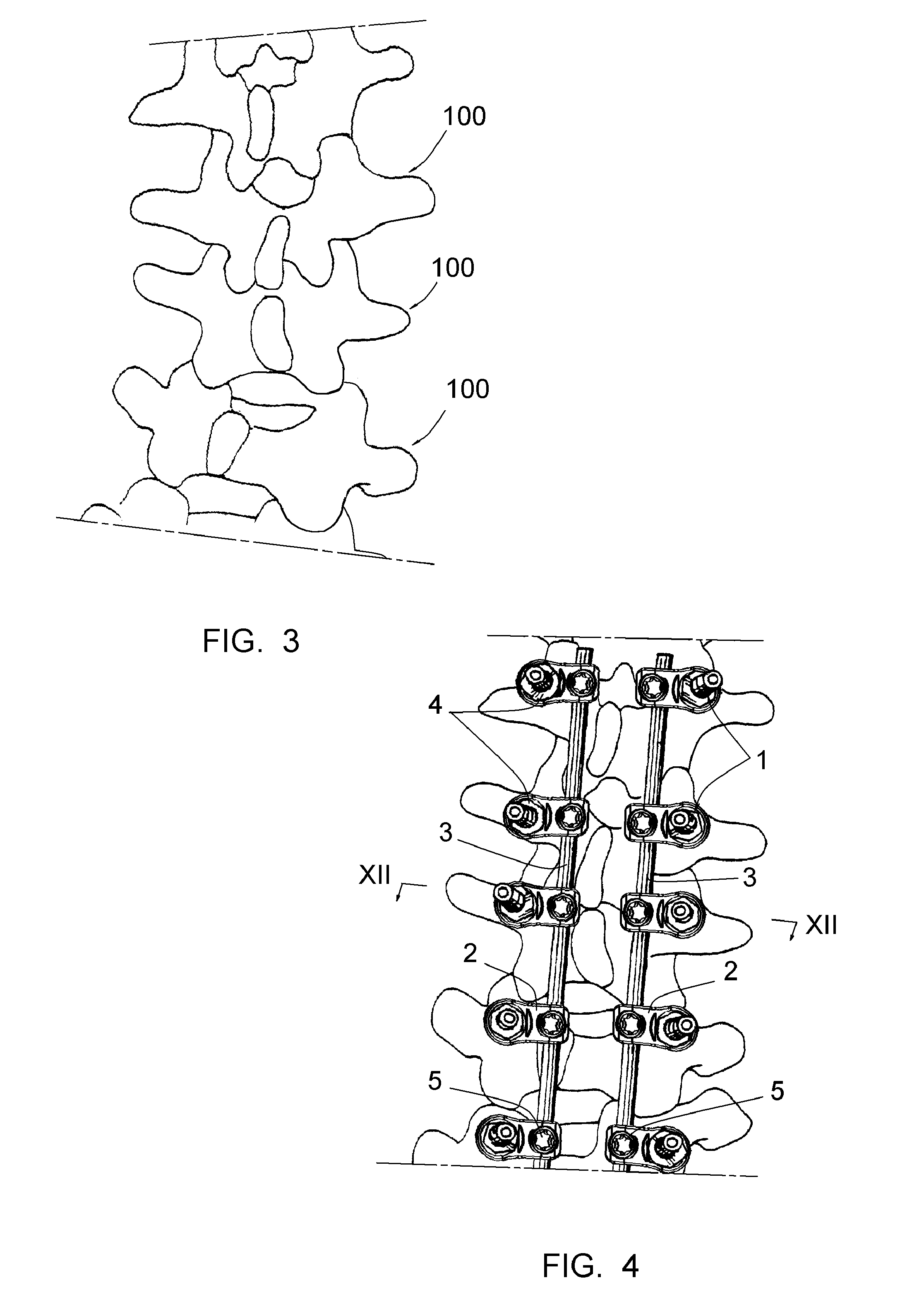 Method for rotating a vertebra or vertebrae