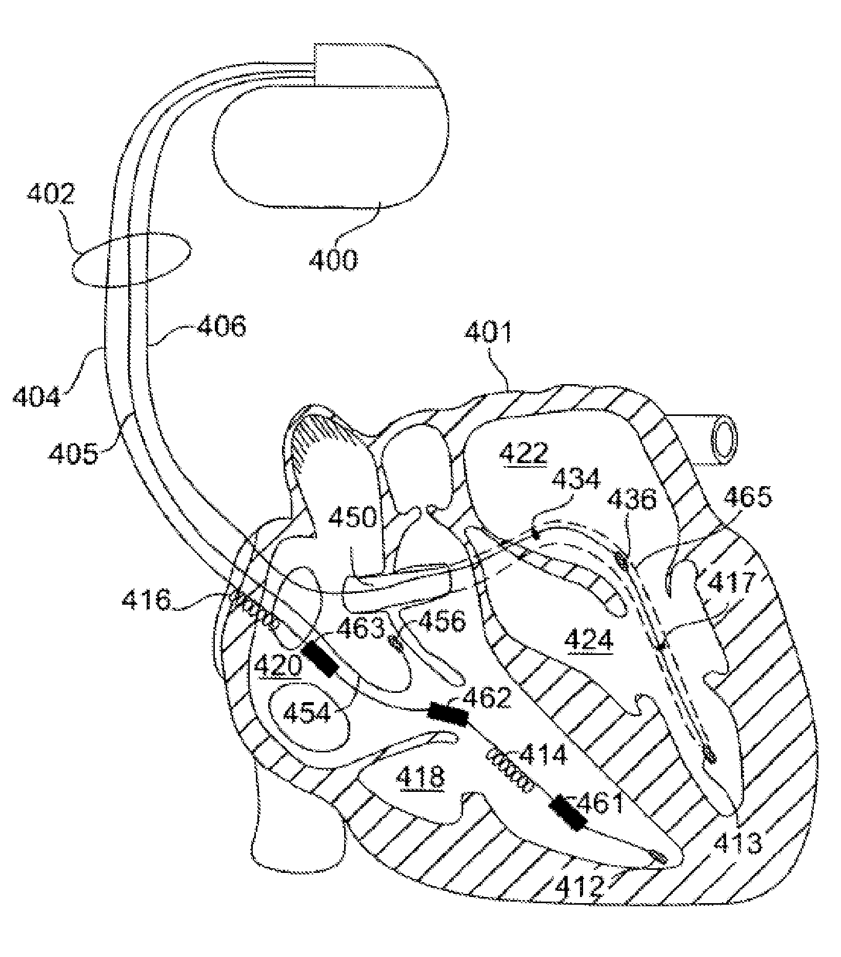 Styrene-isobutylene copolymers and medical devices containing the same