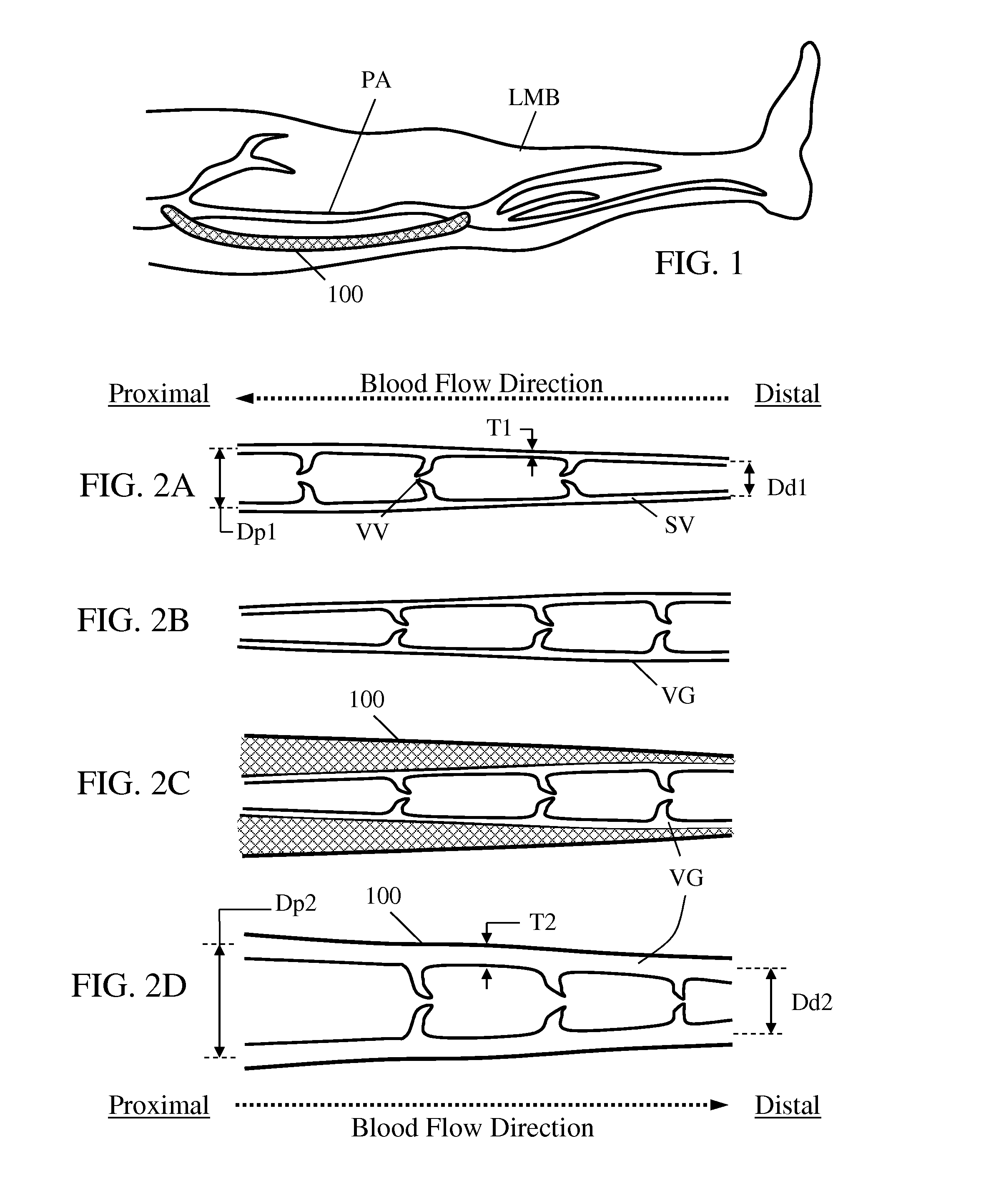 External support for elongated bodily vessels