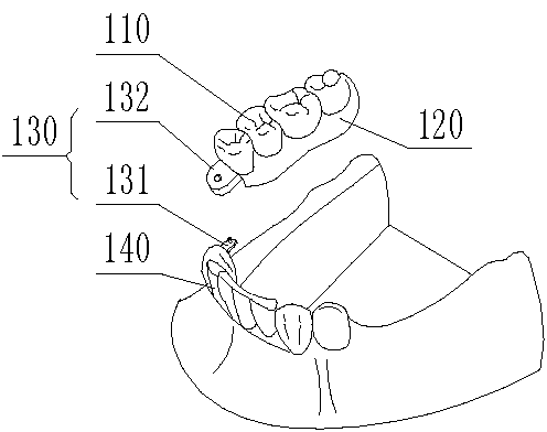 Stress-interrupted attachment dentures