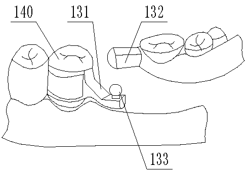 Stress-interrupted attachment dentures