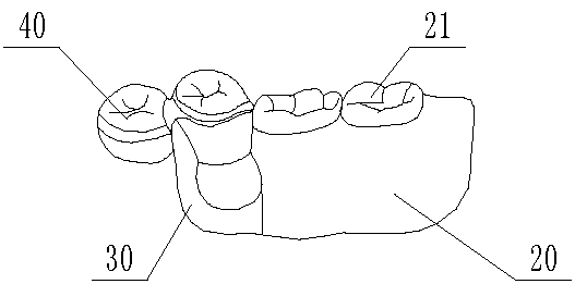 Stress-interrupted attachment dentures