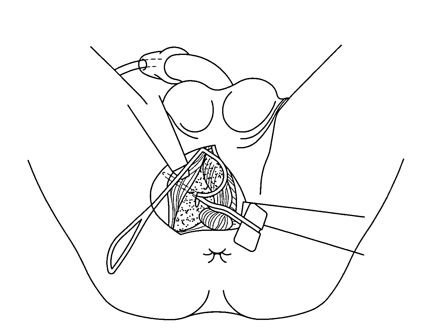 Surgical technique and tools for use in treatment of male urinary incontinence