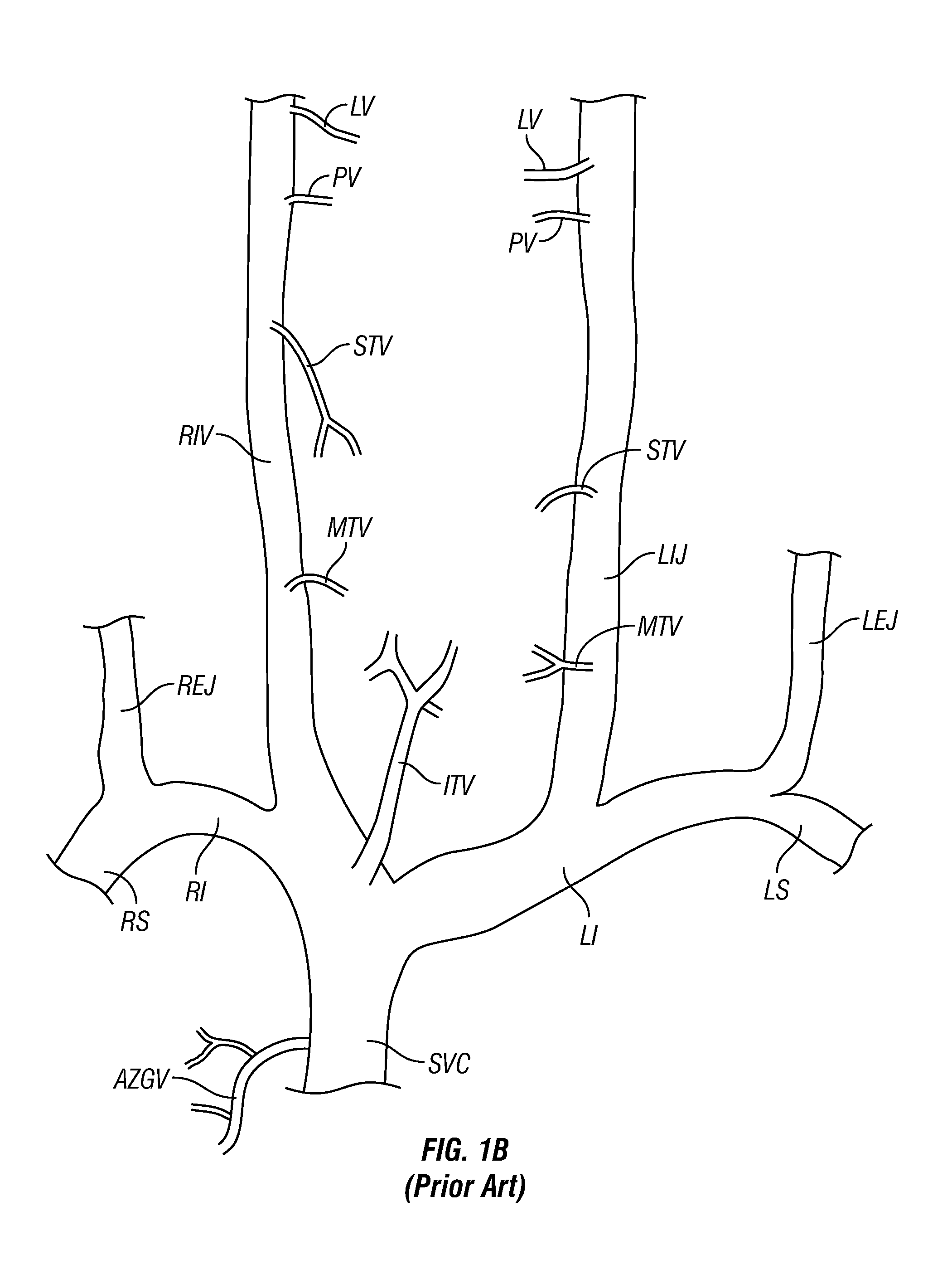 Methods, Systems and Devices for Treatment of Cerebrospinal Venous Insufficiency and Multiple Sclerosis