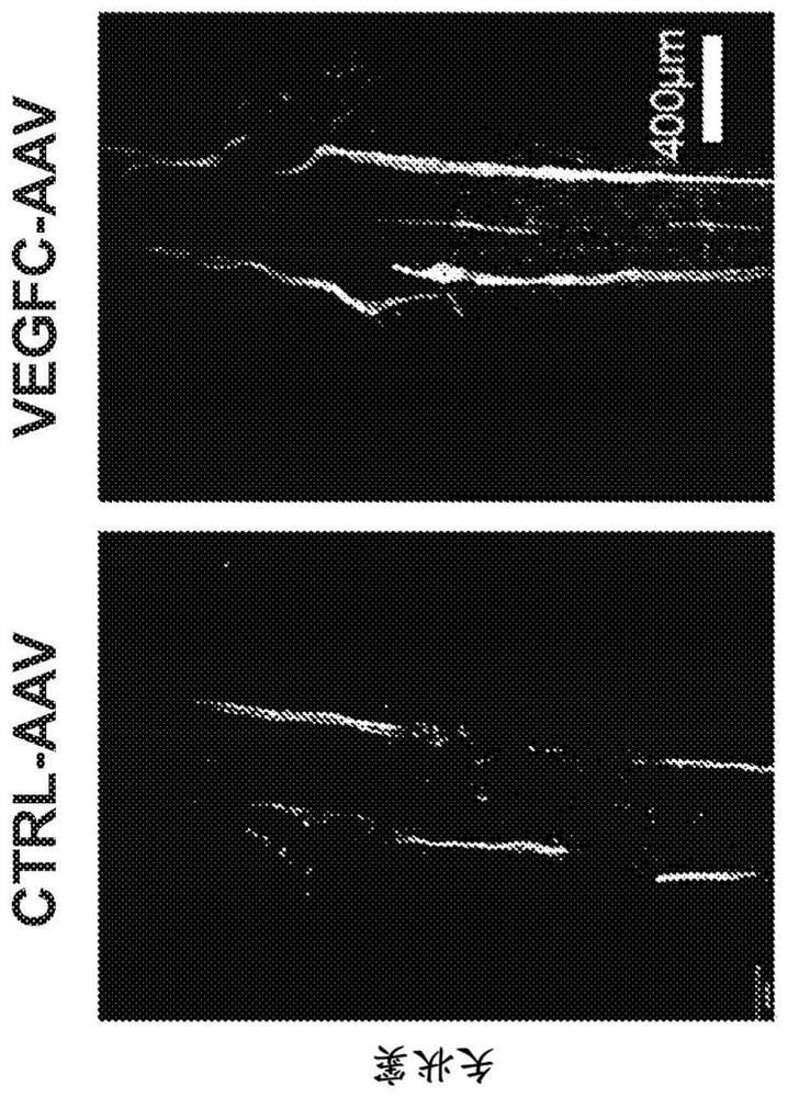 Manipulation of meningeal lymphatic vasculature for brain and CNS tumor therapy