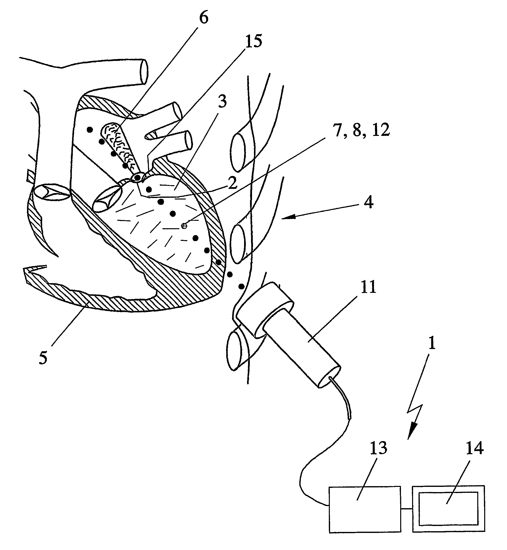 Method and device for ultrasound measurement of blood flow