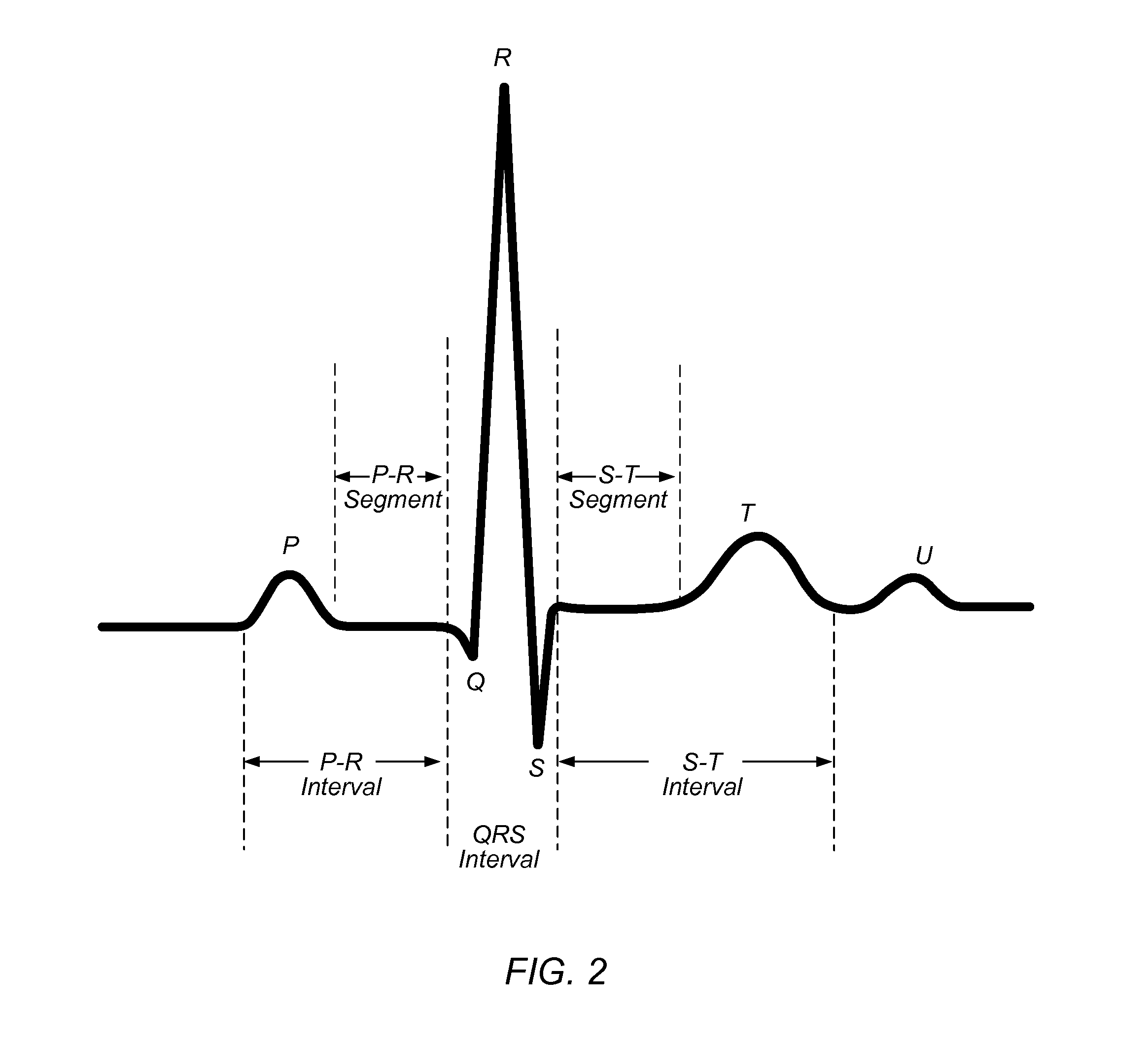 Electrocardiogram Analysis and Parameter Estimation