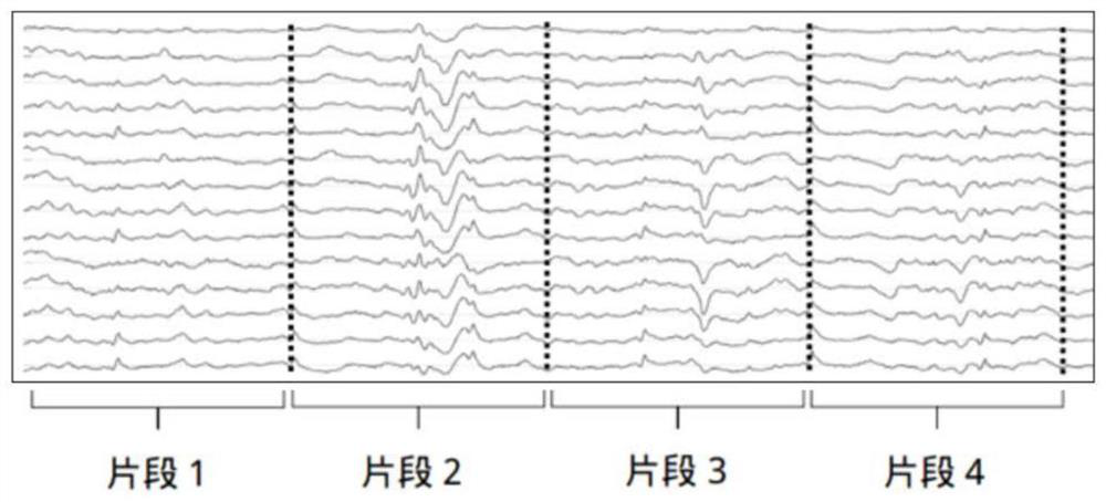 Automatic detection method for epilepsy electroencephalography (EEG)/magnetoencephalography (MEG) abnormal waves and positioning system