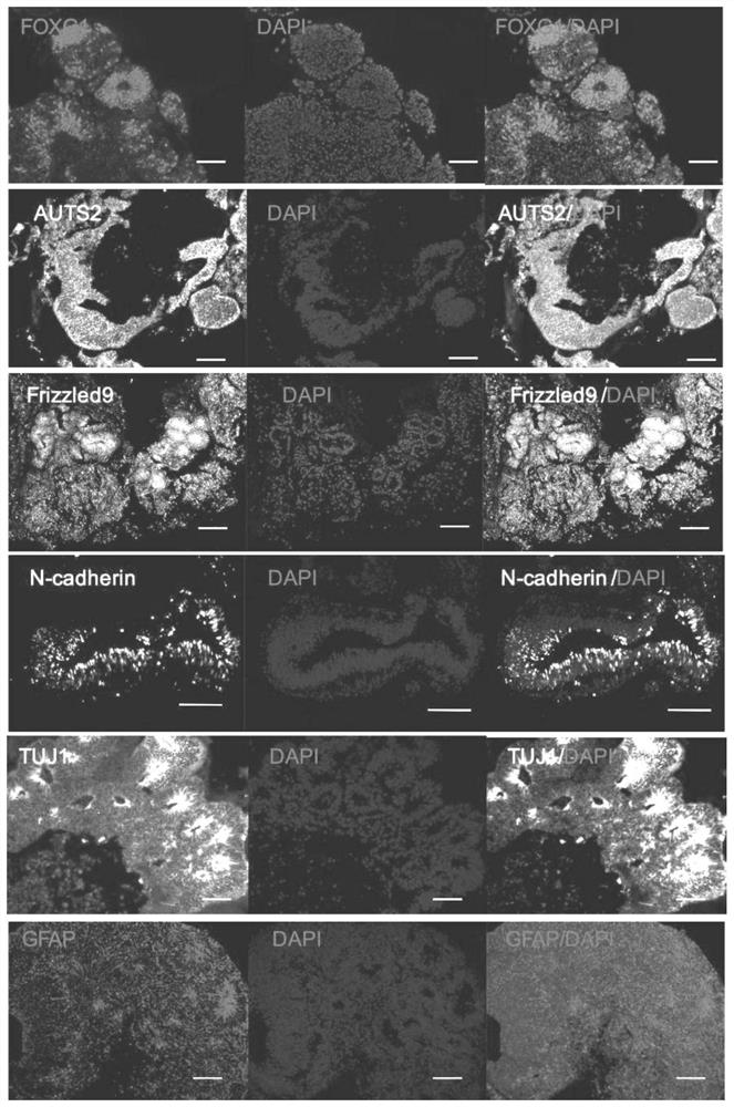 Construction method and application of glioblastoma organoid model