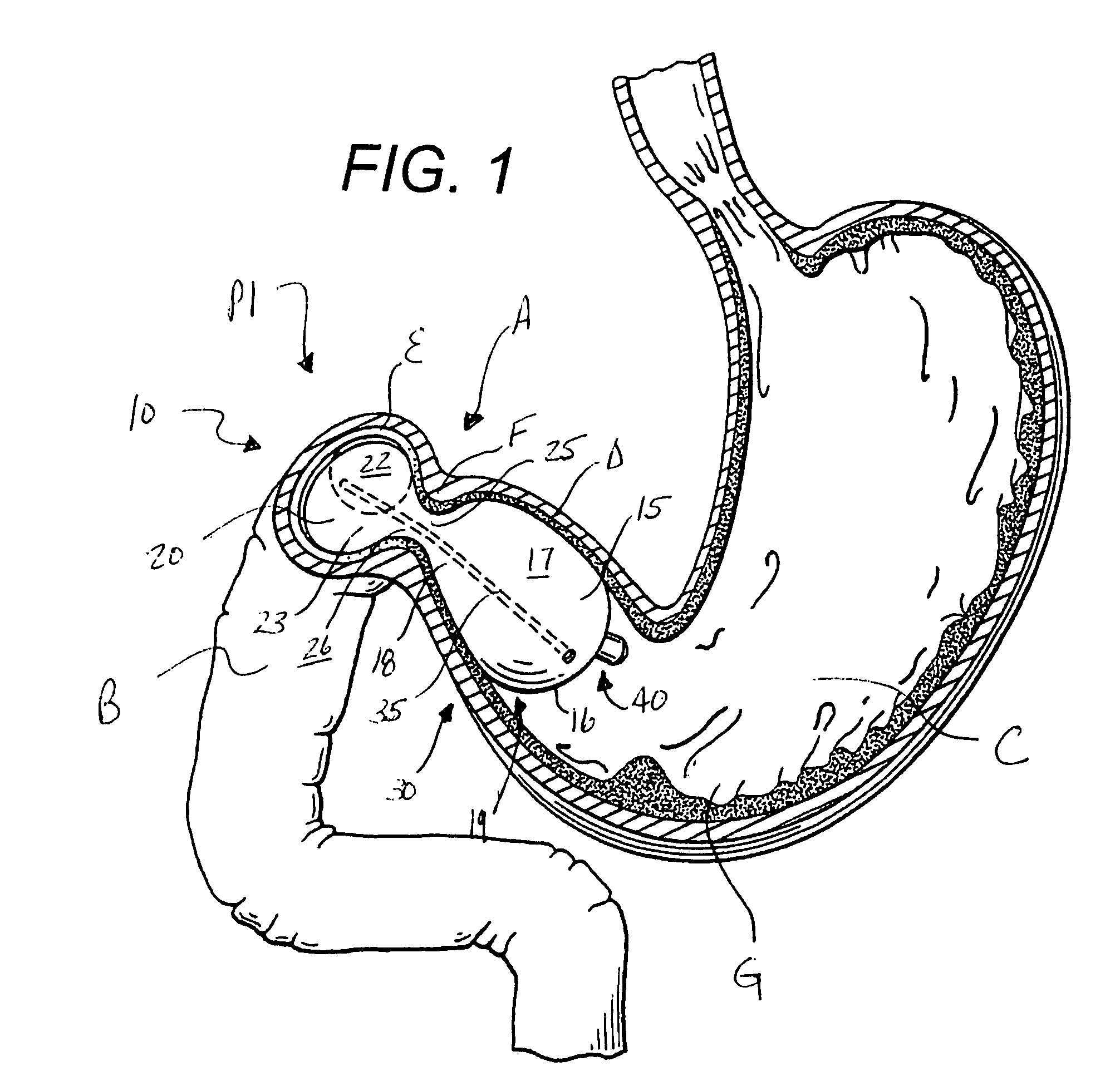 Implantable weight control device