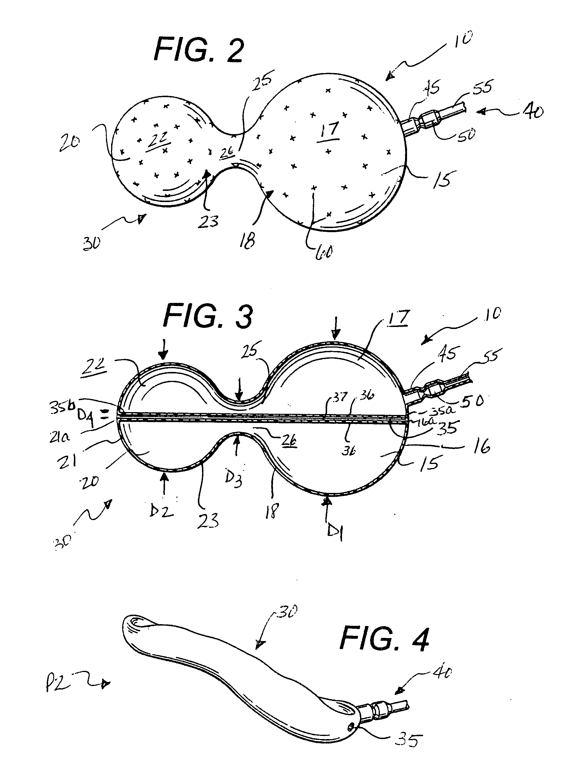 Implantable weight control device