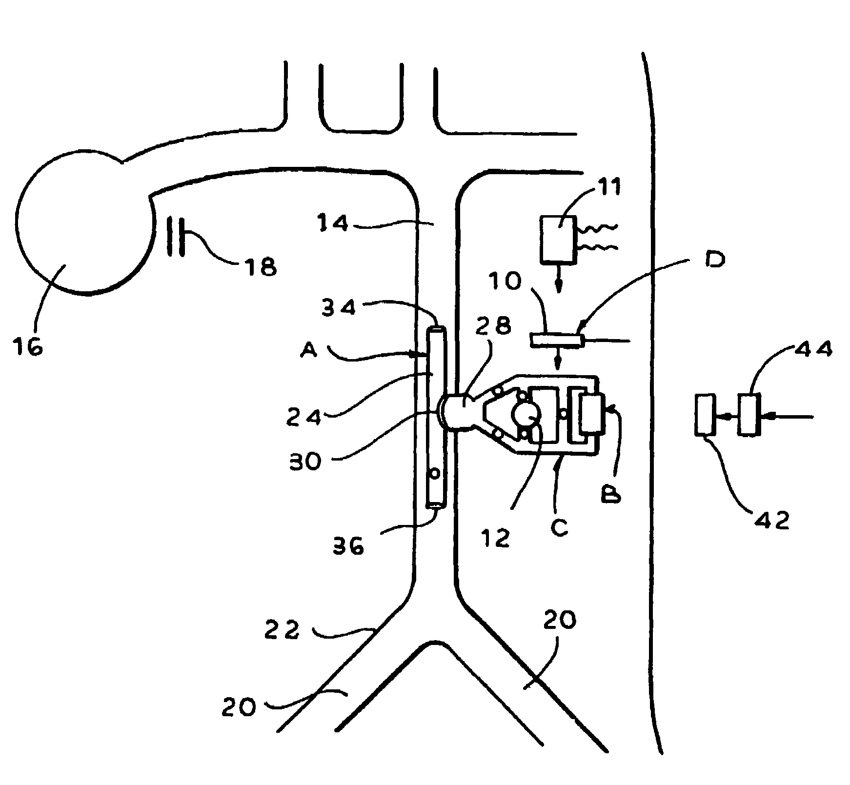 Implantable counterpulsation cardiac assist device