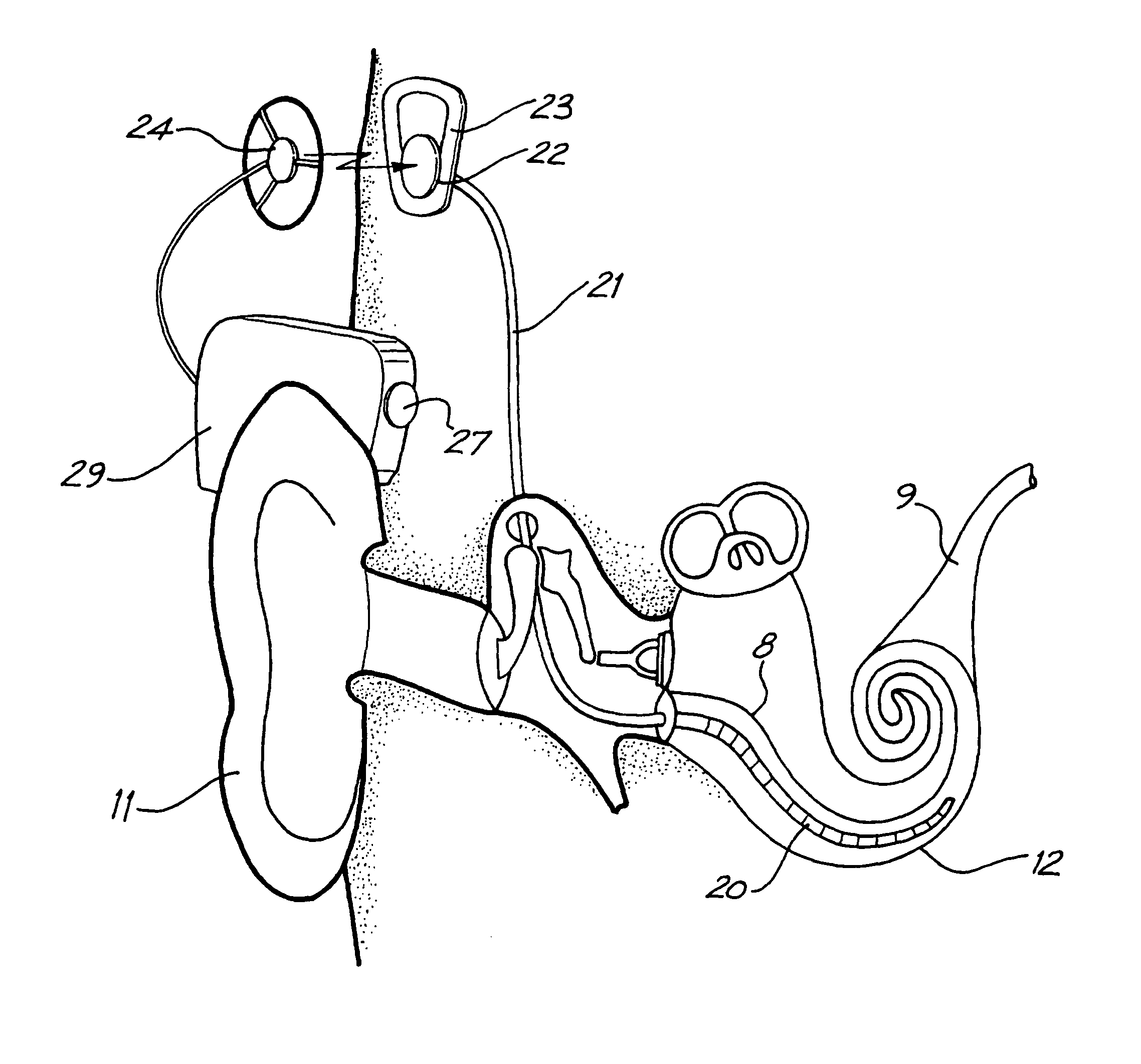 Control of shape of an implantable electrode array