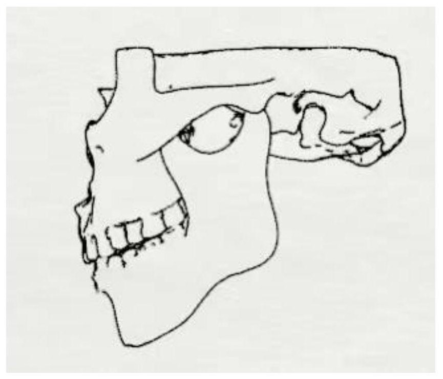 Bone class III malocclusion digital diagnosis method and system based on biomechanics