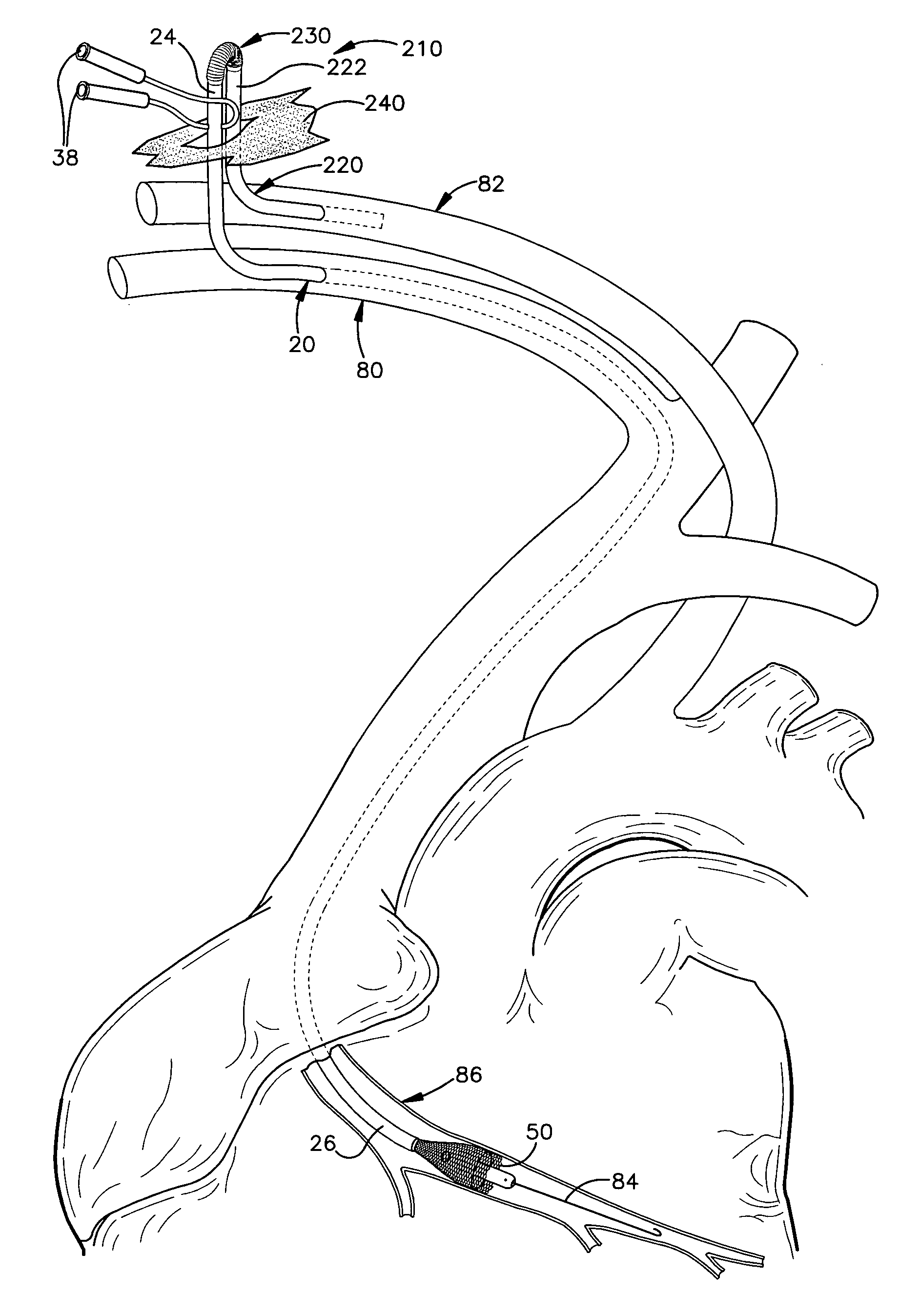 Apparatus and method for auto-retroperfusion of a coronary vein