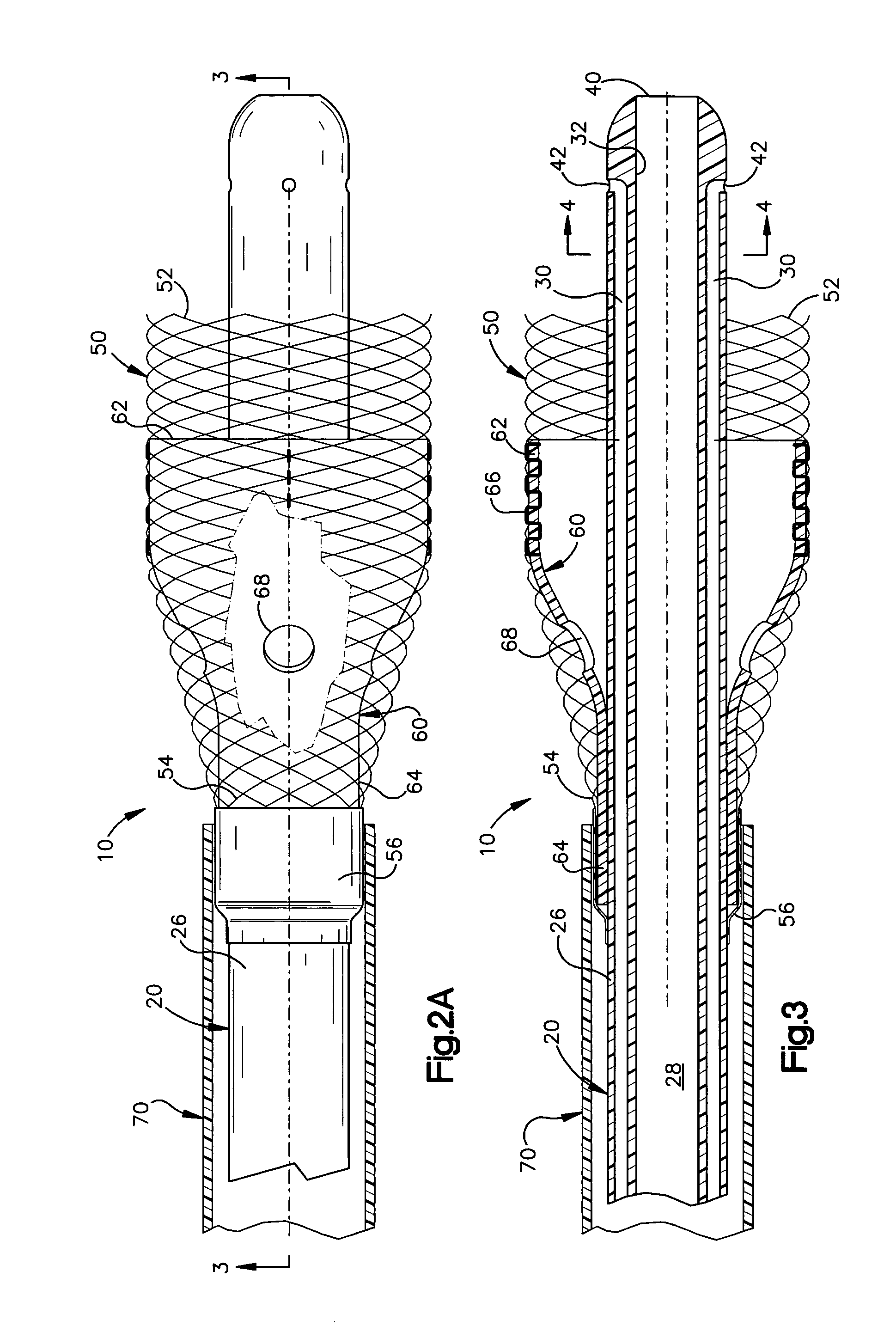 Apparatus and method for auto-retroperfusion of a coronary vein