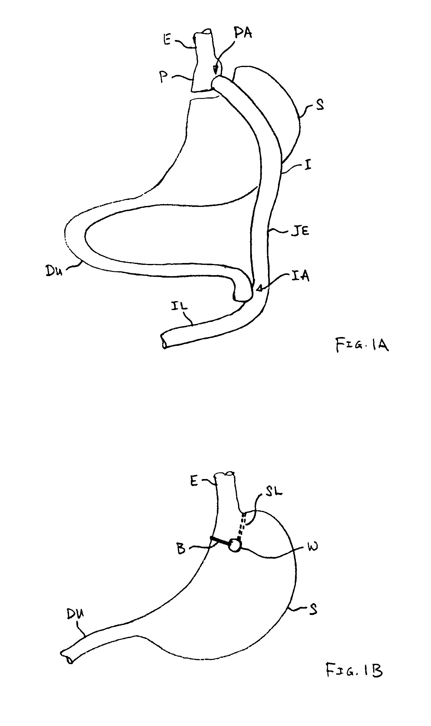 Methods and apparatus for revision of obesity procedures